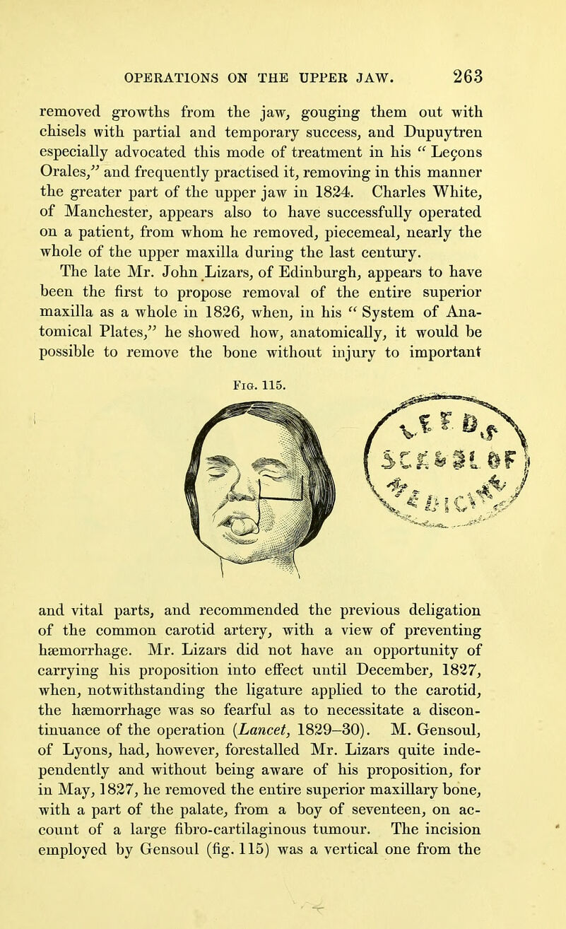 removed growths from the jaw, gouging them out with chisels with partial and temporary success, and Dupuytren especially advocated this mode of treatment in his  Lecons Orales, and frequently practised it, removing in this manner the greater part of the upper jaw in 1824. Charles White, of Manchester, appears also to have successfully operated on a patient, from whom he removed, piecemeal, nearly the whole of the upper maxilla during the last century. The late Mr. John Lizars, of Edinburgh, appears to have been the first to propose removal of the entire superior maxilla as a whole in 1826, when, in his  System of Ana- tomical Plates, he showed how, anatomically, it would be possible to remove the bone without injury to important and vital parts, and recommended the previous deligation of the common carotid artery, with a view of preventing haemorrhage. Mr. Lizars did not have an opportunity of carrying his proposition into effect until December, 1827, when, notwithstanding the ligature applied to the carotid, the haemorrhage was so fearful as to necessitate a discon- tinuance of the operation {Lancet, 1829—30). M. Gensoul, of Lyons, had, however, forestalled Mr. Lizars quite inde- pendently and without being aware of his proposition, for in May, 1827, he removed the entire superior maxillary bone, with a part of the palate, from a boy of seventeen, on ac- count of a large fibro-cartilaginous tumour. The incision employed by Gensoul (fig. 115) was a vertical one from the Fig. 115.