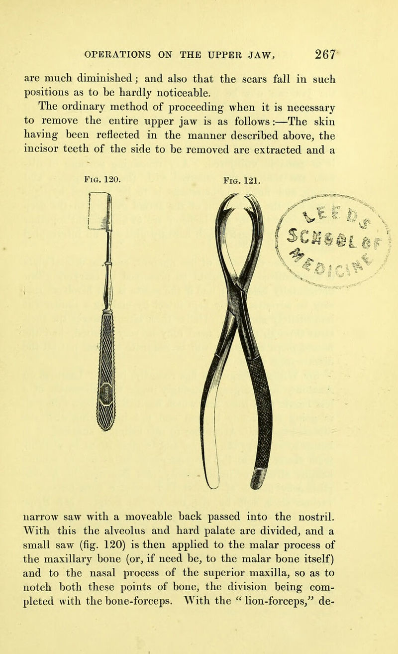 are much diminished; and also that the scars fall in such positions as to be hardly noticeable. The ordinary method of proceeding when it is necessary to remove the entire upper jaw is as follows:—The skin having been reflected in the manner described above, the incisor teeth of the side to be removed are extracted and a Fig. 120. Fig. 121. narrow saw with a moveable back passed into the nostril. With this the alveolus and hard palate are divided, and a small saw (fig. 120) is then applied to the malar process of the maxillary bone (or, if need be, to the malar bone itself) and to the nasal process of the superior maxilla, so as to notch both these points of bone, the division being com- pleted with the bone-forceps. With the  lion-forceps, de-