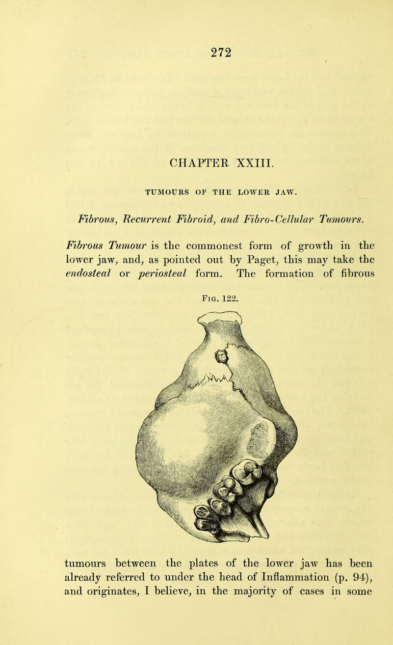 CHAPTER XXIII. TUMOURS OF THE LOWER JAW. Fibrous, Recurrent Fibroid, and Fibro-Cellular Tumours. Fibrous Tumour is the commonest form of growth in the lower jaw, and, as pointed out by Paget, this may take the endosteal or periosteal form. The formation of fibrous Fig. 122. tumours between the plates of the lower jaw has been already referred to under the head of Inflammation (p. 94), and originates, I believe, in the majority of cases in some