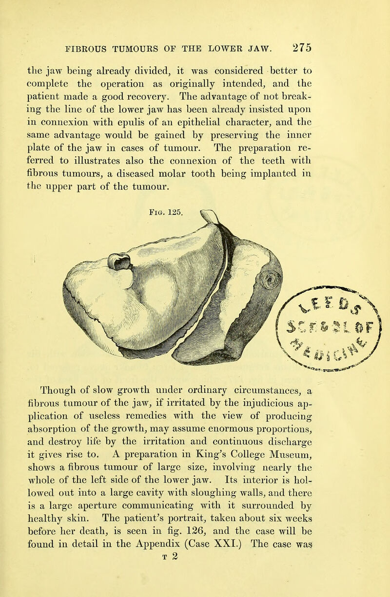 the jaw being already divided, it was considered better to complete the operation as originally intended, and the patient made a good recovery. The advantage of not break- ing the line of the lower jaw has been already insisted upon in connexion with epulis of an epithelial character, and the same advantage would be gained by preserving the inner plate of the jaw in cases of tumour. The preparation re- ferred to illustrates also the connexion of the teeth with fibrous tumours, a diseased molar tooth being implanted in the upper part of the tumour. Though of slow growth under ordinary circumstances, a fibrous tumour of the jaw, if irritated by the injudicious ap- plication of useless remedies with the view of producing absorption of the growth, may assume enormous proportions, and destroy life by the irritation and continuous discharge it gives rise to. A preparation in King's College Museum, shows a fibrous tumour of large size, involving nearly the whole of the left side of the lower jaw. Its interior is hol- lowed out into a large cavity with sloughing walls, and there is a large aperture communicating with it surrounded by healthy skin. The patient's portrait, taken about six weeks before her death, is seen in fig. 126, and the case will be found in detail in the Appendix (Case XXL) The case was t 2