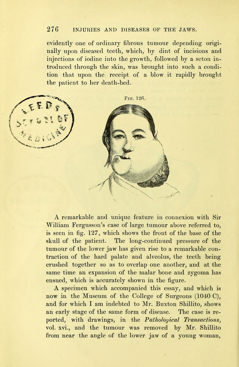 evidently one of ordinary fibrous tumour depending origi- nally upon diseased teeth, which, by dint of incisions and injections of iodine into the growth, followed by a seton in- troduced through the skin, was brought into such a condi- tion that upon the receipt of a blow it rapidly brought the patient to her death-bed. A remarkable and unique feature in connexion with Sir William Fergusson's case of large tumour above referred to, is seen in fig. 127, which shows the front of the base of the skull of the patient. The long-continued pressure of the tumour of the lower jaw has given rise to a remarkable con- traction of the hard palate and alveolus, the teeth being crushed together so as to overlap one another, and at the same time an expansion of the malar bone and zygoma has ensued, which is accurately shown in the figure. A specimen which accompanied this essay, and which is now in the Museum of the College of Surgeons (1040 C), and for which I am indebted to Mr. Buxton Shillito, shows an early stage of the same form of disease. The case is re- ported, with drawings, in the Pathological Transactions, vol. xvi., and the tumour was removed by Mr. Shillito from near the angle of the lower jaw of a young woman,