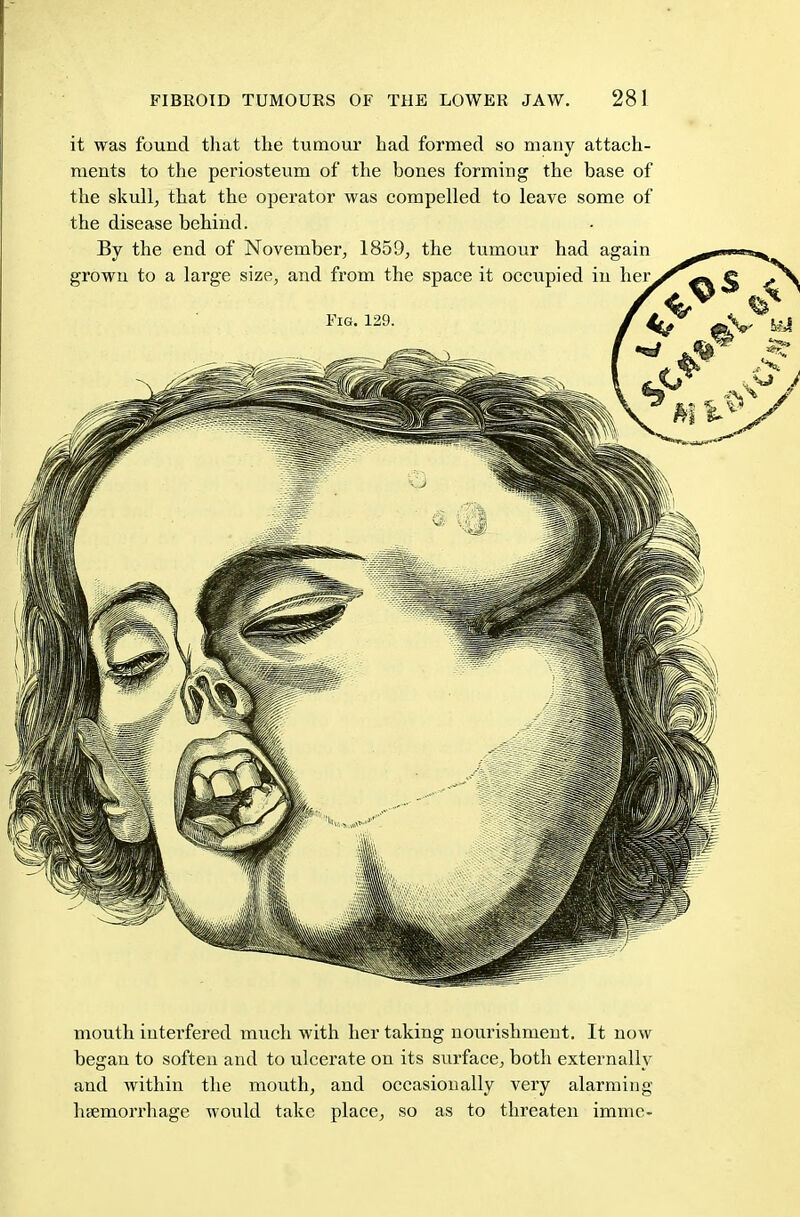 it was found that the tumour had formed so many attach- ments to the periosteum of the bones forming the base of the skull, that the operator was compelled to leave some of the disease behind. mouth interfered much with her taking nourishment. It now began to soften and to ulcerate on its surface, both externally and within the mouth, and occasionally very alarming haemorrhage would take place, so as to threaten imme-