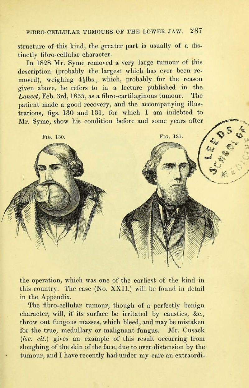 structure of this kind, the greater part is usually of a dis- tinctly fibro-cellular character. In 1828 Mr. Syme removed a very large tumour of this description (probably the largest which has ever been re- moved), weighing 4£lbs., which, probably for the reason given above, he refers to in a lecture published in the Lancet, Feb. 3rd, 1855, as a fibro-cartilaginous tumour. The patient made a good recovery, and the accompanying illus- trations, figs. 130 and 131, for which I am indebted to Mr. Syme, show his condition before and some years after Fig. 130. Fig. 131. the operation, which was one of the earliest of the kind in this country. The case (No. XXII.) will be found in detail in the Appendix. The fibro-cellular tumour, though of a perfectly benign character, will, if its surface be irritated by caustics, &c, throw out fungous masses, which bleed, and may be mistaken for the true, medullary or malignant fungus. Mr. Cusack {Joe. cit.) gives an example of this result occurring from sloughing of the skin of the face, due to over-distension by the tumour, and I have recently had under my care an extraordi-