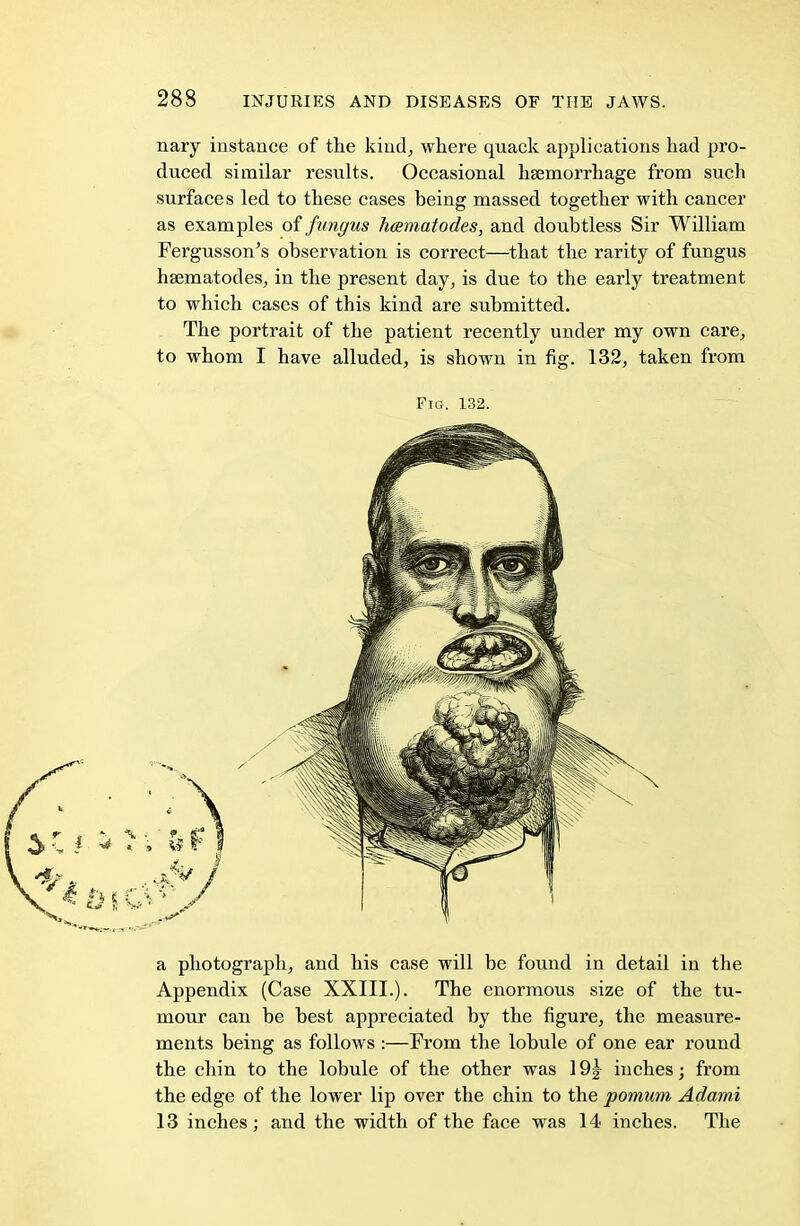 nary instance of the kind, where quack applications had pro- duced similar results. Occasional haemorrhage from such surfaces led to these cases being massed together with cancer as examples of fungus hcsmatodes, and doubtless Sir William Fergusson's observation is correct—that the rarity of fungus hsematodes, in the present day, is due to the early treatment to which cases of this kind are submitted. The portrait of the patient recently under my own care, to whom I have alluded, is shown in fig. 132, taken from Fig. 132. a photograph, and his case will be found in detail in the Appendix (Case XXIII.). The enormous size of the tu- mour can be best appreciated by the figure, the measure- ments being as follows :—From the lobule of one ear round the chin to the lobule of the other was 19\ inches; from the edge of the lower lip over the chin to the pomum Adamt 13 inches; and the width of the face was 14 inches. The