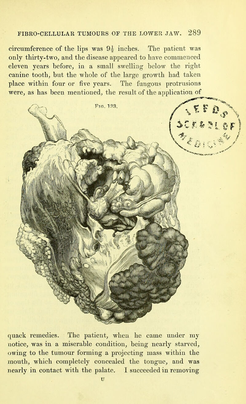 circumference of the lips was 9^ inches. The patient was only thirty-two, and the disease appeared to have commenced eleven years before, in a small swelling below the right canine tooth, but the whole of the large growth had taken place within four or five years. The fungous protrusions were, as has been mentioned, the result of the application of quack remedies. The patient, when he came under my notice, was in a miserable condition, being nearly starved, owing to the tumour forming a projecting mass within the mouth, which completely concealed the tongue, and was nearly in contact with the palate. I succeeded in removing u