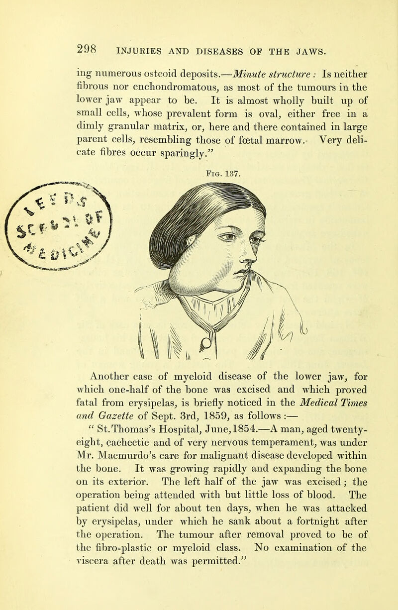 ing numerous osteoid deposits.—Minute structure : Is neither fibrous nor enchondromatous, as most of the tumours in the lower jaw appear to be. It is almost wholly built up of small cells, whose prevalent form is oval, either free in a dimly granular matrix, or, here and there contained in large parent cells, resembling those of foetal marrow. Very deli- cate fibres occur sparingly. Another case of myeloid disease of the lower jaw, for which one-half of the bone was excised and which proved fatal from erysipelas, is briefly noticed in the Medical Times and Gazette of Sept. 3rd, 1859, as follows :—  St. Thomas's Hospital, June, 1854.—A man, aged twenty- eight, cachectic and of very nervous temperament, was under Mr. Macmurdo's care for malignant disease developed within the bone. It was growing rapidly and expanding the bone on its exterior. The left half of the jaw was excised; the operation being attended with but little loss of blood. The patient did well for about ten days, when he was attacked by erysipelas, under which he sank about a fortnight after the operation. The tumour after removal proved to be of the fibro-plastic or myeloid class. No examination of the viscera after death was permitted. Pig. 137.