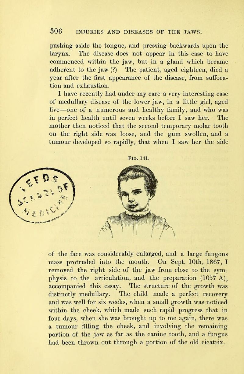 pushing aside the tongue, and pressing backwards upon the larynx. The disease does not appear in this case to have commenced within the jaw, but in a gland which became adherent to the jaw (?) The patient aged eighteen, died a year after the first appearance of the disease, from suffoca- tion and exhaustion. I have recently had under my care a very interesting case of medullary disease of the lower jaw, in a little girl, aged five—one of a numerous and healthy family, and who was in perfect health until seven weeks before I saw her. The mother then noticed that the second temporary molar tooth on the right side was loose, and the gum swollen, and a tumour developed so rapidly, that when I saw her the side of the face was considerably enlarged, and a large fungous mass protruded into the mouth. On Sept. 10th, 1867, I removed the right side of the jaw from close to the sym- physis to the articulation, and the preparation (1057 A), accompanied this essay. The structure of the growth was distinctly medullary. The child made a perfect recovery and was well for six weeks, when a small growth was noticed within the cheek, which made such rapid progress that in four days, when she was brought up to me again, there was a tumour filling the cheek, and involving the remaining portion of the jaw as far as the canine tooth, and a fungus had been thrown out through a portion of the old cicatrix. Pig. 141.