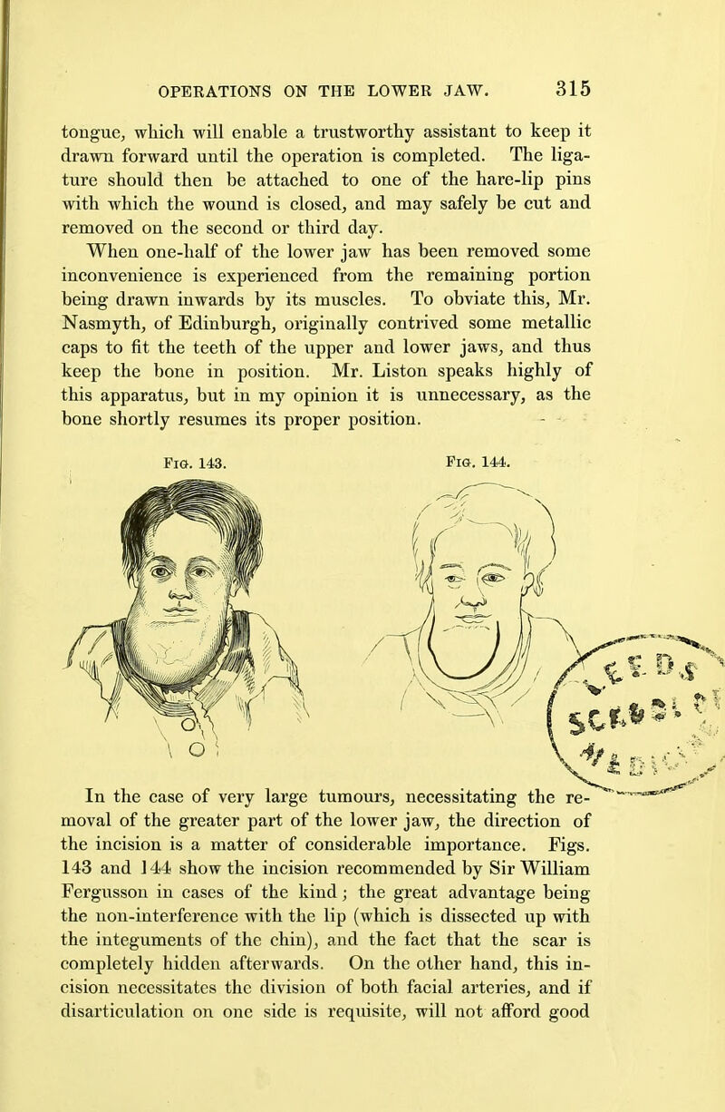 tongue, which will enable a trustworthy assistant to keep it drawn forward until the operation is completed. The liga- ture should then be attached to one of the hare-lip pins with which the wound is closed, and may safely be cut and removed on the second or third day. When one-half of the lower jaw has been removed some inconvenience is experienced from the remaining portion being drawn inwards by its muscles. To obviate this, Mr. Nasmyth, of Edinburgh, originally contrived some metallic caps to fit the teeth of the upper and lower jaws, and thus keep the bone in position. Mr. Liston speaks highly of this apparatus, but in my opinion it is unnecessary, as the bone shortly resumes its proper position. In the case of very large tumours, necessitating the re- moval of the greater part of the lower jaw, the direction of the incision is a matter of considerable importance. Figs. 143 and 144 show the incision recommended by Sir William Fergusson in cases of the kind; the great advantage being the non-interference with the lip (which is dissected up with the integuments of the chin), and the fact that the scar is completely hidden afterwards. On the other hand, this in- cision necessitates the division of both facial arteries, and if disarticulation on one side is requisite, will not afford good Pig. 143. Pig. 144.