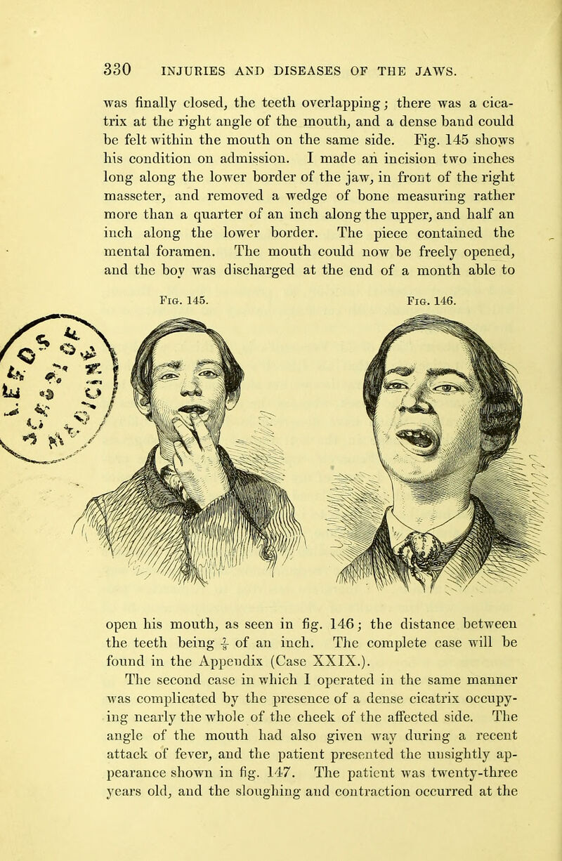 was finally closed, the teeth overlapping; there was a cica- trix at the right angle of the mouth, and a dense band could be felt within the mouth on the same side. Fig. 145 shows his condition on admission. I made ah incision two inches long along the lower border of the jaw, in front of the right masseter, and removed a wedge of bone measuring rather more than a quarter of an inch along the upper, and half an inch along the lower border. The piece contained the mental foramen. The mouth could now be freely opened, and the boy was discharged at the end of a month able to Fi&. 145. Fig. 146. open his mouth, as seen in fig. 146; the distance between the teeth being of an inch. The complete case will be found in the Appendix (Case XXIX.). The second case in which 1 operated in the same manner was complicated by the presence of a dense cicatrix occupy- ing nearly the whole of the cheek of the affected side. The angle of the mouth had also given way during a recent attack of fever, and the patient presented the unsightly ap- pearance shown in fig. 147. The patient was twenty-three years old, and the sloughing and contraction occurred at the