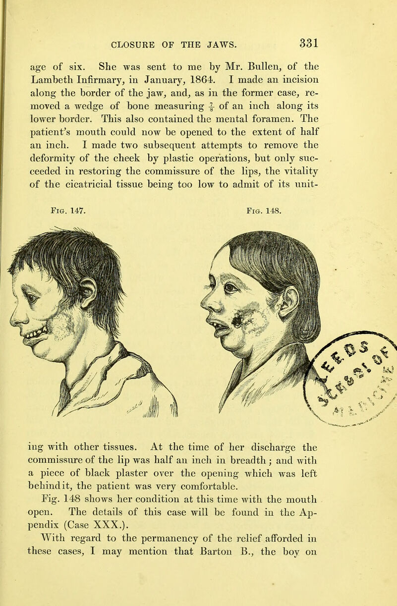 age of six. She was sent to me by Mr. Bullen, of the Lambeth Infirmary, in January, 1864. I made an incision along the border of the jaw, and, as in the former case, re- moved a wedge of bone measuring -J of an inch along its lower border. This also contained the mental foramen. The patient's mouth could now be opened to the extent of half an inch. I made two subsequent attempts to remove the deformity of the cheek by plastic operations, but only suc- ceeded in restoring the commissure of the lips, the vitality of the cicatricial tissue being too low to admit of its unit- Fig. 147. Fig. 148. ing with other tissues. At the time of her discharge the commissure of the lip was half an inch in breadth ; and with a piece of black plaster over the opening which was left behind it, the patient was very comfortable. Fig. 148 shows her condition at this time with the mouth open. The details of this case will be found in the Ap- pendix (Case XXX.). With regard to the permanency of the relief afforded in these cases, I may mention that Barton B., the boy on