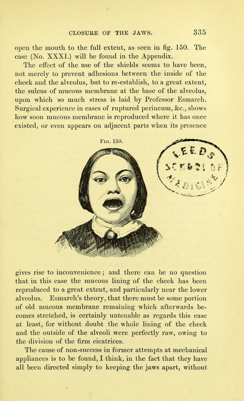 open the mouth to the full extent, as seen in fig. 150. The case (No. XXXI.) will be found in the Appendix. The effect of the use of the shields seems to have been, not merely to prevent adhesions between the inside of the cheek and the alveolus, but to re-establish, to a great extent, the sulcus of mucous membrane at the base of the alveolus, upon which so much stress is laid by Professor Esmarch. Surgical experience in cases of raptured perineum, &c, shows how soon mucous membrane is reproduced where it has once existed, or even appears on adjacent parts when its presence gives rise to inconvenience; and there can be no question that in this case the mucous lining of the cheek has been reproduced to a great extent, and particularly near the lower alveolus. Esmarch's theory, that there must be some portion of old mucous membrane remaining which afterwards be- comes stretched, is certainly untenable as regards this case at least, for without doubt the whole lining of the cheek and the outside of the alveoli were perfectly raw, owing to the division of the firm cicatrices. The cause of non-success in former attempts at mechanical appliances is to be found, I think, in the fact that they have all been directed simply to keeping the jaws apart, without