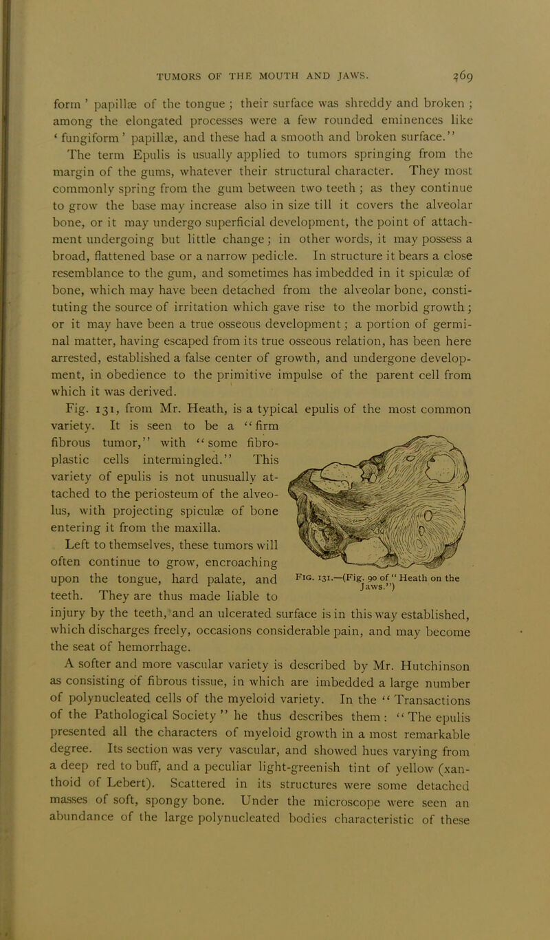 form ' papillae of the tongue ; their surface was shreddy and broken ; among the elongated processes were a few rounded eminences like * fungiform' papillae, and these had a smooth and broken surface. The term Epulis is usually applied to tumors springing from the margin of the gums, whatever their structural character. They most commonly spring from the gum between two teeth ; as they continue to grow the base may increase also in size till it covers the alveolar bone, or it may undergo superficial development, the point of attach- ment undergoing but little change; in other words, it may possess a broad, flattened base or a narrow pedicle. In structure it bears a close resemblance to the gum, and sometimes has imbedded in it spiculae of bone, which may have been detached from the alveolar bone, consti- tuting the source of irritation which gave rise to the morbid growth; or it may have been a true osseous development; a portion of germi- nal matter, having escaped from its true osseous relation, has been here arrested, established a false center of growth, and undergone develop- ment, in obedience to the primitive impulse of the parent cell from which it was derived. Fig. 131, from Mr. Heath, is a typical epulis of the most common variety. It is seen to be a firm fibrous tumor, with some fibro- plastic cells intermingled. This variety of epulis is not unusually at- tached to the periosteum of the alveo- lus, with projecting spiculse of bone entering it from the maxilla. Left to themselves, these tumors will often continue to grow, encroaching upon the tongue, hard palate, and teeth. They are thus made liable to injury by the teeth, and an ulcerated surface is in this way established, which discharges freely, occasions considerable pain, and may become the seat of hemorrhage. A softer and more vascular variety is described by Mr. Hutchinson as consisting of fibrous tissue, in which are imbedded a large number of polynucleated cells of the myeloid variety. In the  Transactions of the Pathological Society  he thus describes them:  The epulis presented all the characters of myeloid growth in a most remarkable degree. Its section was very vascular, and showed hues varying from a deep red to buff, and a peculiar light-greenish tint of yellow (xan- thoid of Lebert). Scattered in its structures were some detached masses of soft, spongy bone. Under the microscope were seen an abundance of the large polynucleated bodies characteristic of these Fig. 131.—(Fig. 90 of Heath on the Jaws.)