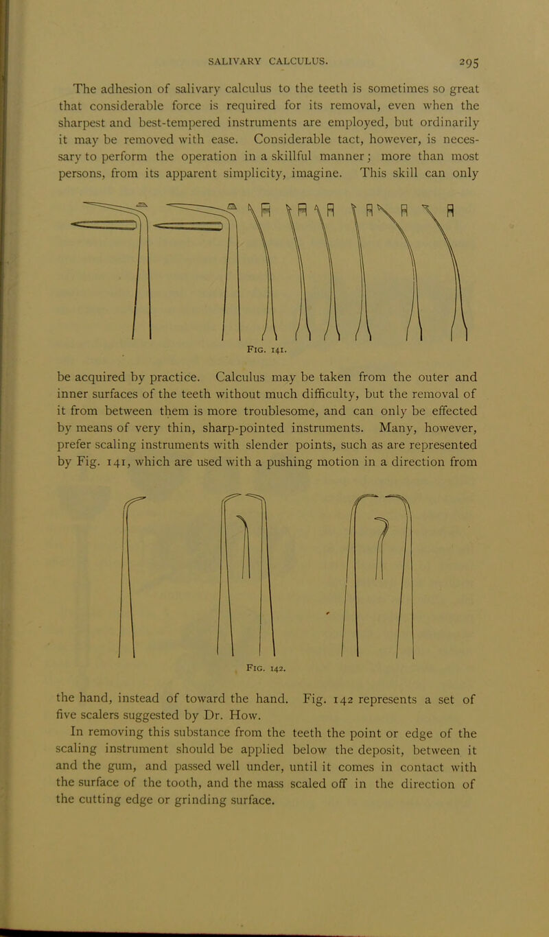 The adhesion of salivary calculus to the teeth is sometimes so great that considerable force is required for its removal, even when the sharpest and best-tempered instruments are employed, but ordinarily it may be removed with ease. Considerable tact, however, is neces- sary to perform the operation in a skillful manner; more than most persons, from its apparent simplicity, imagine. This skill can only Fig. 14.1. be acquired by practice. Calculus may be taken from the outer and inner surfaces of the teeth without much difficulty, but the removal of it from between them is more troublesome, and can only be effected by means of very thin, sharp-pointed instruments. Many, however, prefer scaling instruments with slender points, such as are represented by Fig. 141, which are used with a pushing motion in a direction from Fig. 142. the hand, instead of toward the hand. Fig. 142 represents a set of five scalers suggested by Dr. How. In removing this substance from the teeth the point or edge of the scaling instrument should be applied below the deposit, between it and the gum, and passed well under, until it comes in contact with the surface of the tooth, and the mass scaled off in the direction of the cutting edge or grinding surface.