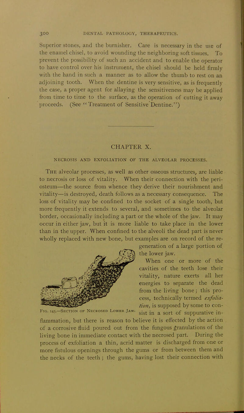 Superior stones, and the burnisher. Care is necessary in the use of the enamel chisel, to avoid wounding the neighboring soft tissues. To prevent the possibility of such an accident and to enable the operator to have control over his instrument, the chisel should be held firmly with the hand in such a manner as to allow the thumb to rest on an adjoining tooth. When the dentine is very sensitive, as is frequently the case, a proper agent for allaying the sensitiveness may be applied from time to time to the surface, as the operation of cutting it away proceeds. (See Treatment of Sensitive Dentine.) CHAPTER X. NECROSIS AND EXFOLIATION OF THE ALVEOLAR PROCESSES. The alveolar processes, as well as other osseous structures, are liable to necrosis or loss of vitality. When their connection with the peri- osteum—the source from whence they derive their nourishment and vitality—is destroyed, death follows as a necessary consequence. The loss of vitality may be confined to the socket of a single tooth, but more frequently it extends to several, and sometimes to the alveolar border, occasionally including a part or the whole of the jaw. It may occur in either jaw, but it is more liable to take place in the lower than in the upper. When confined to the alveoli the dead part is never wholly replaced with new bone, but examples are on record of the re- generation of a large portion of the lower jaw. When one or more of the cavities of the teeth lose their vitality, nature exerts all her energies to separate the dead ;>^':-;;V from the living bone : this pro- '  cess, technically termed exfolia- tion, is supposed by some to con- F.g. 145-Section of Necrosed Lower Jaw. ^ ^ a ^ Qf SUppurative in- flammation, but there is reason to believe it is effected by the action of a corrosive fluid poured out from the fungous granulations of the living bone in immediate contact with the necrosed part. During the process of exfoliation a thin, acrid matter is discharged from one or more fistulous openings through the gums or from between them and the necks of the teeth ; the gums, having lost their connection with