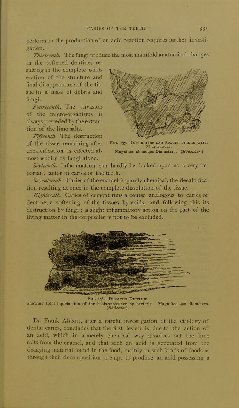 perform in the production of an acid reaction requires further investi- gation. Thirteenth. The fungi produce the most manifold anatomical changes in the softened dentine, re- sulting in the complete oblit- eration of the structure and final disappearance of the tis- sue in a mass of debris and fungi. Fourteenth. The invasion of the micro-organisms is always preceded by the extrac- tion of the lime salts. Fifteenth. The destruction of the tissue remaining after decalcification is effected al- most wholly by fungi alone. Sixteenth. Inflammation can hardly be looked upon as a very im- portant factor in caries of the teeth. Seventeenth. Caries of the enamel is purely chemical, the decalcifica- tion resulting at once in the complete dissolution of the tissue. Eighteenth. Caries of cement runs a course analogous to caries of dentine, a softening of the tissues by acids, and following this its destruction by fungi; a slight inflammatory action on the part of the living matter in the corpuscles is not to be excluded. Fig. 158—Decayed Dentine. Showing total liquefaction of the basis-substance by bacteria. Magnified 400 diameters. (Bodecker). Dr. Frank Abbott, after a careful investigation of the etiology of dental caries, concludes that the first lesion is due to the action of an acid, which in a merely chemical way dissolves out the lime salts from the enamel, and that such an acid is generated from the decaying material found in the food, mainly in such kinds of foods as through their decomposition are apt to produce an acid possessing a Fig. 157.—Interglobular Spaces filled with Micrococci. Magnified about 400 Diameters. (Bodecker.)