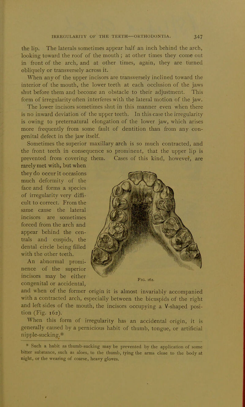 the lip. The laterals sometimes appear half an inch behind the arch, looking toward the roof of the mouth; at other times they come out in front of the arch, and at other times, again, they are turned obliquely or transversely across it. When any of the upper incisors are transversely inclined toward the interior of the mouth, the lower teeth at each occlusion of the jaws shut before them and become an obstacle to their adjustment. This form of irregularity often interferes with the lateral motion of the jaw. The lower incisors sometimes shut in this manner even when there is no inward deviation of the upper teeth. In this case the irregularity is owing to preternatural elongation of the lower jaw, which arises more frequently from some fault of dentition than from any con- genital defect in the jaw itself. Sometimes the superior maxillary arch is so much contracted, and the front teeth in consequence so prominent, that the upper lip is prevented from covering them. Cases of this kind, however, are rarely met with, but when they do occur it occasions much deformity of the face and forms a species of irregularity very diffi- cult to correct. From the same cause the lateral incisors are sometimes forced from the arch and appear behind the cen- trals and cuspids, the dental circle being filled with the other teeth. An abnormal promi- nence of the superior incisors may be either J Fig. 162. congenital or accidental, and when of the former origin it is almost invariably accompanied with a contracted arch, especially between the bicuspids of the right and left sides of the mouth, the incisors occupying a V-shaped posi- tion (Fig. 162). When this form of irregularity has an accidental origin, it is generally caused by a pernicious habit of thumb, tongue, or artificial nipple-sucking.* * Such a habit as thumb-sucking may be prevented by the application of some bitter substance, such as aloes, to the thumb, tying the arms close to the body at night, or the wearing of coarse, heavy gloves.