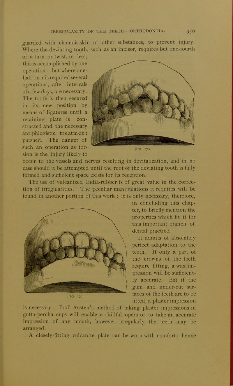 guarded with chamois-skin or other substances, to prevent injury. Where the deviating tooth, such as an incisor, requires but one-fourth of a turn or twist, or less, this is accomplished by one operation ; but where one- half turn is required several operations, after intervals of a few days, are necessary. The tooth is then secured in its new position by means of ligatures until a retaining plate is con- structed and the necessary antiphlogistic treatment pursued. The danger of such an operation as tor- sion is the injury likely to occur to the vessels and neryes resulting in devitalization, and in no case should it be attempted until the root of the deviating tooth is fully formed and sufficient space exists for its reception. The use of vulcanized India-rubber is of great value in the correc- tion of irregularities. The peculiar manipulations it requires will be found in another portion of this work ; it is only necessary, therefore, in concluding this chap- ter, to briefly mention the properties which fit it for this important branch of dental practice. It admits of absolutely perfect adaptation to the teeth. If only a part of the crowns of the teeth require fitting, a wax im- pression will be sufficient- ly accurate. But if the gum and under-cut sur- faces of the teeth are to be fitted, a plaster impression is necessary. Prof. Austen's method of taking plaster impressions in gutta-percha cups will enable a skillful operator to take an accurate impression of any mouth, however irregularly the teeth may be arranged. A closely-fitting vulcanite plate can be worn with comfort; hence