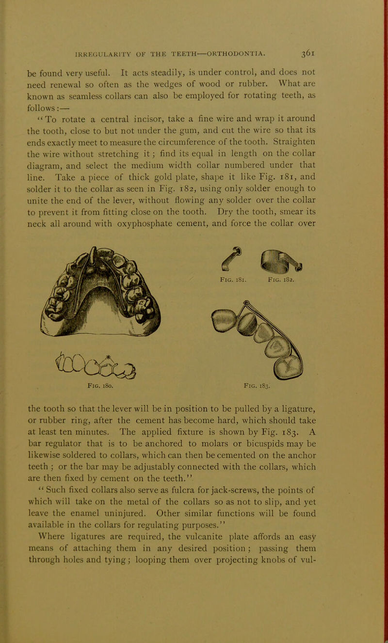 be found very useful. It acts steadily, is under control, and does not need renewal so often as the wedges of wood or rubber. What are known as seamless collars can also be employed for rotating teeth, as follows: — To rotate a central incisor, take a fine wire and wrap it around the tooth, close to but not under the gum, and cut the wire so that its ends exactly meet to measure the circumference of the tooth. Straighten the wire without stretching it; find its equal in length on the collar diagram, and select the medium width collar numbered under that line. Take a piece of thick gold plate, shape it like Fig. 181, and solder it to the collar as seen in Fig. 182, using only solder enough to unite the end of the lever, without flowing any solder over the collar to prevent it from fitting close on the tooth. Dry the tooth, smear its neck all around with oxyphosphate cement, and force the collar over Fig. 180. Fig. 183. the tooth so that the lever will be in position to be pulled by a ligature, or rubber ring, after the cement has become hard, which should take at least ten minutes. The applied fixture is shown by Fig. 183. A bar regulator that is to be anchored to molars or bicuspids may be likewise soldered to collars, which can then be cemented on the anchor teeth ; or the bar may be adjustably connected with the collars, which are then fixed by cement on the teeth.  Such fixed collars also serve as fulcra for jack-screws, the points of which will take on the metal of the collars so as not to slip, and yet leave the enamel uninjured. Other similar functions will be found available in the collars for regulating purposes. Where ligatures are required, the vulcanite plate affords an easy means of attaching them in any desired position; passing them through holes and tying; looping them over projecting knobs of vul-