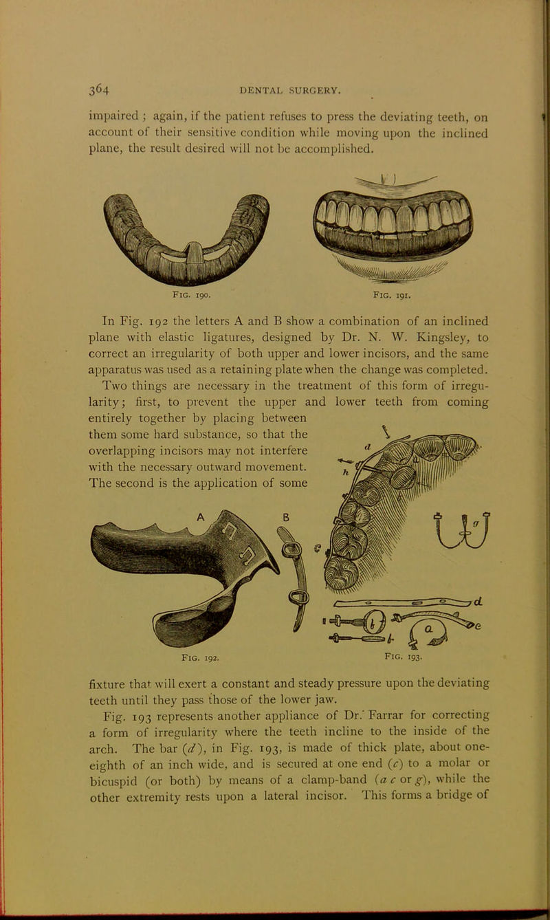 impaired ; again, if the patient refuses to press the deviating teeth, on account of their sensitive condition while moving upon the inclined plane, the result desired will not be accomplished. Fig. 190. Fig. 19L In Fig. 192 the letters A and B show a combination of an inclined plane with elastic ligatures, designed by Dr. N. W. Kingsley, to correct an irregularity of both upper and lower incisors, and the same apparatus was used as a retaining plate when the change was completed. Two things are necessary in the treatment of this form of irregu- larity; first, to prevent the upper and lower teeth from coming entirely together by placing between Fig. 192. Fig. 193. fixture that, will exert a constant and steady pressure upon the deviating teeth until they pass those of the lower jaw. Fig. 193 represents another appliance of Dr.'Farrar for correcting a form of irregularity where the teeth incline to the inside of the arch. The bar (d), in Fig. 193, is made of thick plate, about one- eighth of an inch wide, and is secured at one end (V) to a molar or bicuspid (or both) by means of a clamp-band {a c ox g), while the other extremity rests upon a lateral incisor. This forms a bridge of