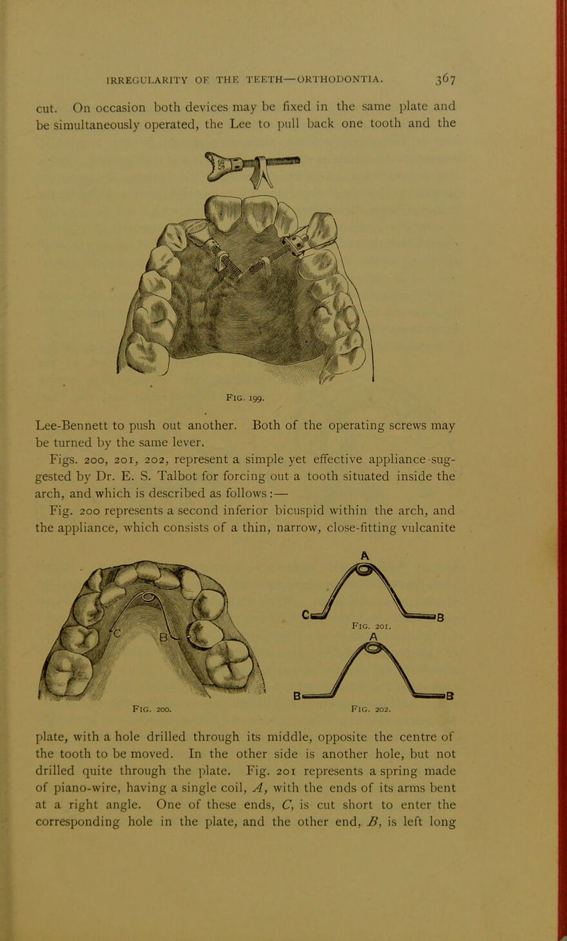 cut. On occasion both devices may be fixed in the same plate and be simultaneously operated, the Lee to pull back one tooth and the Fig. 199. Lee-Bennett to push out another. Both of the operating screws may be turned by the same lever. Figs. 200, 201, 202, represent a simple yet effective appliance sug- gested by Dr. E. S. Talbot for forcing out a tooth situated inside the arch, and which is described as follows :— Fig. 200 represents a second inferior bicuspid within the arch, and the appliance, which consists of a thin, narrow, close-fitting vulcanite Fig. 200. Fig. 202. plate, with a hole drilled through its middle, opposite the centre of the tooth to be moved. In the other side is another hole, but not drilled quite through the plate. Fig. 201 represents a spring made of piano-wire, having a single coil, A, with the ends of its arms bent at a right angle. One of these ends, C, is cut short to enter the corresponding hole in the plate, and the other end, B, is left long