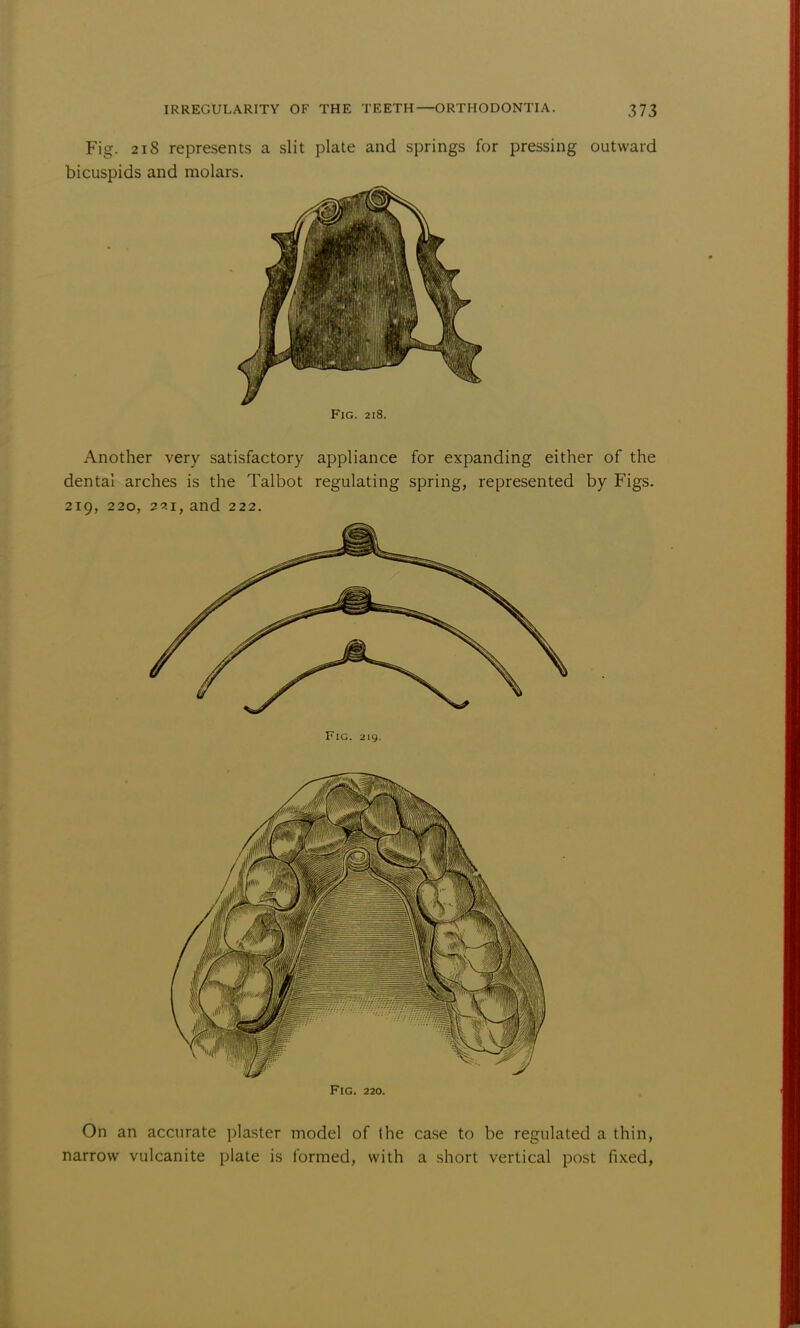 Fig. 218 represents a slit plate and springs for pressing outward bicuspids and molars. Fig. 218. Another very satisfactory appliance for expanding either of the dental arches is the Talbot regulating spring, represented by Figs. 219, 220, 23i, and 222. Fig. 220. On an accurate plaster model of (he case to be regulated a thin, narrow vulcanite plate is formed, with a short vertical post fixed,