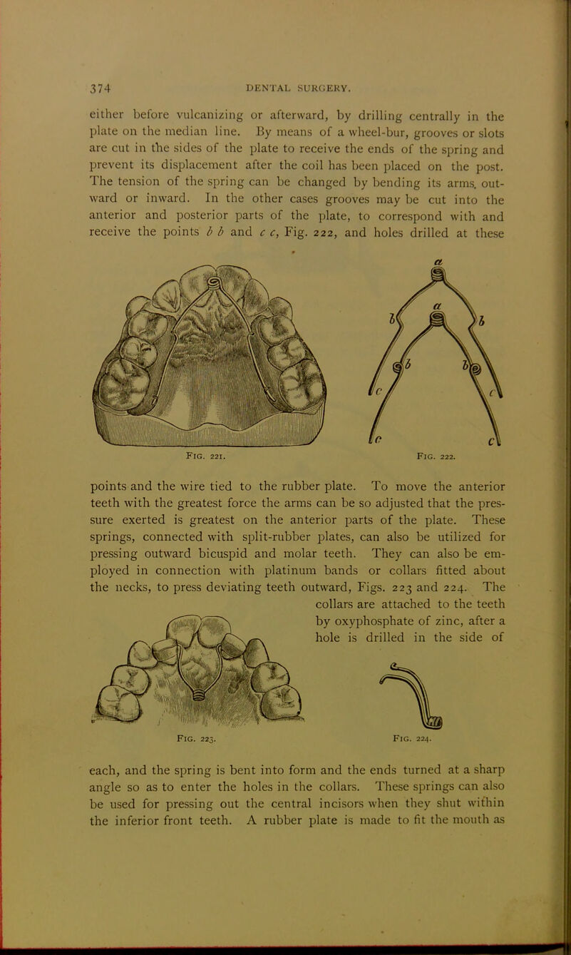 either before vulcanizing or afterward, by drilling centrally in the plate on the median line. By means of a wheel-bur, grooves or slots are cut in the sides of the plate to receive the ends of the spring and prevent its displacement after the coil has been placed on the post. The tension of the spring can be changed by bending its arms, out- ward or inward. In the other cases grooves may be cut into the anterior and posterior parts of the plate, to correspond with and receive the points b b and c c, Fig. 222, and holes drilled at these Fig. 221. Fig. 222. points and the wire tied to the rubber plate. To move the anterior teeth with the greatest force the arms can be so adjusted that the pres- sure exerted is greatest on the anterior parts of the plate. These springs, connected with split-rubber plates, can also be utilized for pressing outward bicuspid and molar teeth. They can also be em- ployed in connection with platinum bands or collars fitted about the necks, to press deviating teeth outward, Figs. 223 and 224. The collars are attached to the teeth Fig. 223. Fig. 224. each, and the spring is bent into form and the ends turned at a sharp angle so as to enter the holes in the collars. These springs can also be used for pressing out the central incisors when they shut within the inferior front teeth. A rubber plate is made to fit the mouth as