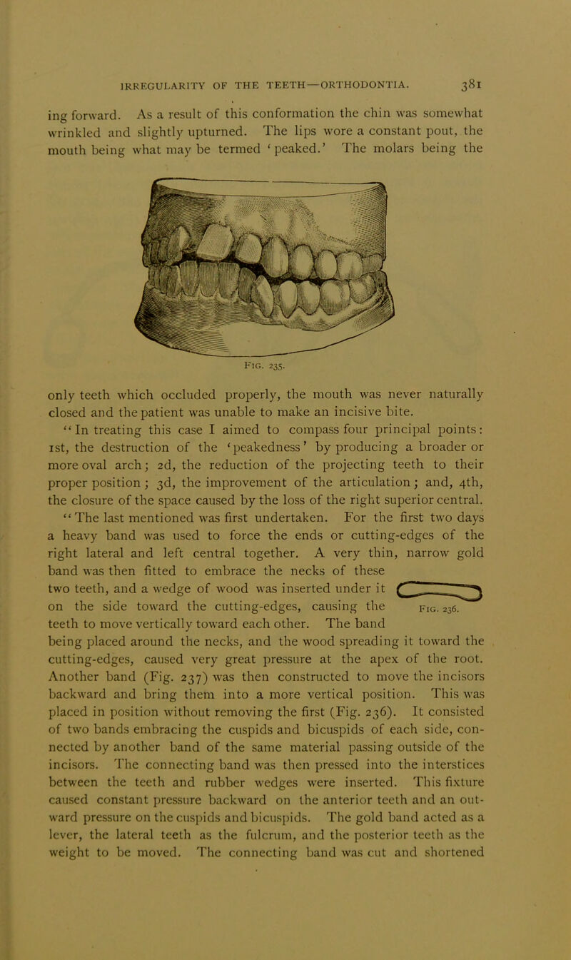 ing forward. As a result of this conformation the chin was somewhat wrinkled and slightly upturned. The lips wore a constant pout, the mouth being what may be termed 'peaked.' The molars being the Fig. 235. only teeth which occluded properly, the mouth was never naturally closed and the patient was unable to make an incisive bite. In treating this case I aimed to compass four principal points: 1st, the destruction of the 'peakedness' by producing a broader or more oval arch; 2d, the reduction of the projecting teeth to their proper position ; 3d, the improvement of the articulation; and, 4th, the closure of the space caused by the loss of the right superior central.  The last mentioned was first undertaken. For the first two days a heavy band was used to force the ends or cutting-edges of the right lateral and left central together. A very thin, narrow gold band was then fitted to embrace the necks of these two teeth, and a wedge of wood was inserted under it ^^^^ on the side toward the cutting-edges, causing the fig. 236. teeth to move vertically toward each other. The band being placed around the necks, and the wood spreading it toward the cutting-edges, caused very great pressure at the apex of the root. Another band (Fig. 237) was then constructed to move the incisors backward and bring them into a more vertical position. This was placed in position without removing the first (Fig. 236). It consisted of two bands embracing the cuspids and bicuspids of each side, con- nected by another band of the same material passing outside of the incisors. The connecting band was then pressed into the interstices between the teeth and rubber wedges were inserted. This fixture caused constant pressure backward on the anterior teeth and an out- ward pressure on the cuspids and bicuspids. The gold band acted as a lever, the lateral teeth as the fulcrum, and the posterior teeth as the weight to be moved. The connecting band was cut and shortened