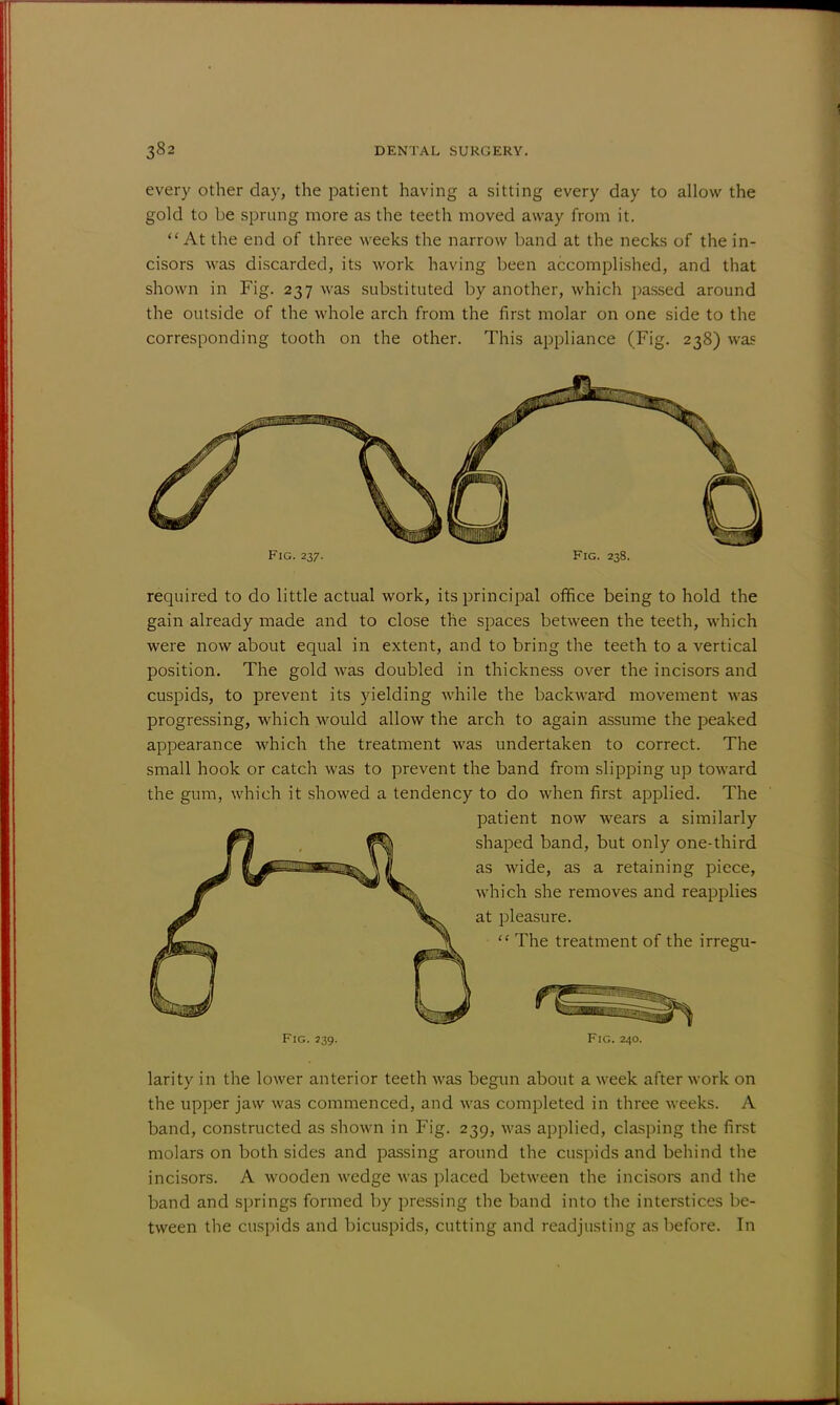 every other day, the patient having a sitting every day to allow the gold to be sprung more as the teeth moved away from it. At the end of three weeks the narrow band at the necks of the in- cisors was discarded, its work having been accomplished, and that shown in Fig. 237 was substituted by another, which passed around the outside of the whole arch from the first molar on one side to the corresponding tooth on the other. This appliance (Fig. 238) was Fig. 237. Fig. 238. required to do little actual work, its principal office being to hold the gain already made and to close the spaces between the teeth, which were now about equal in extent, and to bring the teeth to a vertical position. The gold was doubled in thickness over the incisors and cuspids, to prevent its yielding while the backward movement was progressing, which would allow the arch to again assume the peaked appearance which the treatment was undertaken to correct. The small hook or catch was to prevent the band from slipping up toward the gum, which it showed a tendency to do when first applied. The patient now wears a similarly shaped band, but only one-third as wide, as a retaining piece, which she removes and reapplies at pleasure.  The treatment of the irregu- FiG. 239. Fig. 240. larity in the lower anterior teeth was begun about a week after work on the upper jaw was commenced, and was completed in three weeks. A band, constructed as shown in Fig. 239, was applied, clasping the first molars on both sides and passing around the cuspids and behind the incisors. A wooden wedge was placed between the incisors and the band and springs formed by pressing the band into the interstices be- tween the cuspids and bicuspids, cutting and readjusting as before. In