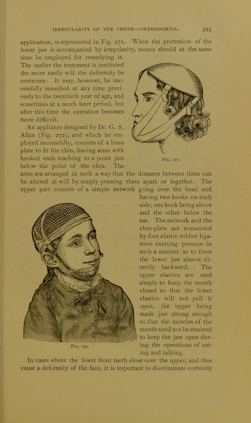 application, is represented in Fig. 271. When the protrusion of the lower jaw is accompanied by irregularity, means should at the same time be employed for remedying it. The earlier the treatment is instituted the more easily will the deformity be overcome. It may, however, be suc- cessfully remedied at any time previ- ously to the twentieth year of age, and sometimes at a much later period, but after this time the operation becomes more difficult. An appliance designed by Dr. G. S. Allan (Fig. 272), and which he em- ployed successfully, consists of a brass plate to fit the chin, having arms with hooked ends reaching to a point just below the point of the chin. The arms are arranged in such a way that the distance between them can be altered at will by simply pressing them apart or together. The upper part consists of a simple network going over the head and having two hooks on each side, one hook being above and the other below the ear. The network and the chin-plate are connected by four elastic rubber liga- tures exerting pressure in such a manner as to force the lower jaw almost di- rectly backward. The upper elastics are used simply to keep the mouth closed so that the lower elastics will not pull it open, the upper being made just strong enough so that the muscles of the mouth need not be strained wlfiik t0 keep the jaw open dur- ing the operations of eat- ing and talking. In cases where the lower front teeth close over the upper, and thus cause a deformity of the face, it is important to discriminate correctly