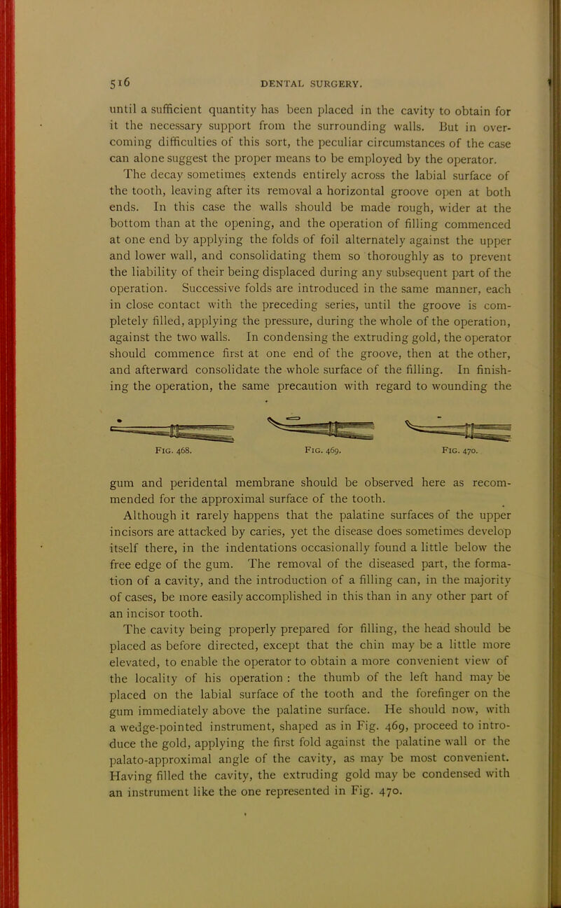 until a sufficient quantity has been placed in the cavity to obtain for it the necessary support from the surrounding walls. But in over- coming difficulties of this sort, the peculiar circumstances of the case can alone suggest the proper means to be employed by the operator. The decay sometimes extends entirely across the labial surface of the tooth, leaving after its removal a horizontal groove open at both ends. In this case the walls should be made rough, wider at the bottom than at the opening, and the operation of filling commenced at one end by applying the folds of foil alternately against the upper and lower wall, and consolidating them so thoroughly as to prevent the liability of their being displaced during any subsequent part of the operation. Successive folds are introduced in the same manner, each in close contact with the preceding series, until the groove is com- pletely filled, applying the pressure, during the whole of the operation, against the two walls. In condensing the extruding gold, the operator should commence first at one end of the groove, then at the other, and afterward consolidate the whole surface of the filling. In finish- ing the operation, the same precaution with regard to wounding the Fig. 468. Fig. 469. Fig. 470. gum and peridental membrane should be observed here as recom- mended for the approximal surface of the tooth. Although it rarely happens that the palatine surfaces of the upper incisors are attacked by caries, yet the disease does sometimes develop itself there, in the indentations occasionally found a little below the free edge of the gum. The removal of the diseased part, the forma- tion of a cavity, and the introduction of a filling can, in the majority of cases, be more easily accomplished in this than in any other part of an incisor tooth. The cavity being properly prepared for filling, the head should be placed as before directed, except that the chin may be a little more elevated, to enable the operator to obtain a more convenient view of the locality of his operation : the thumb of the left hand may be placed on the labial surface of the tooth and the forefinger on the gum immediately above the palatine surface. He should now, with a wedge-pointed instrument, shaped as in Fig. 469, proceed to intro- duce the gold, applying the first fold against the palatine wall or the palato-approximal angle of the cavity, as may be most convenient. Having filled the cavity, the extruding gold may be condensed with an instrument like the one represented in Fig. 470.