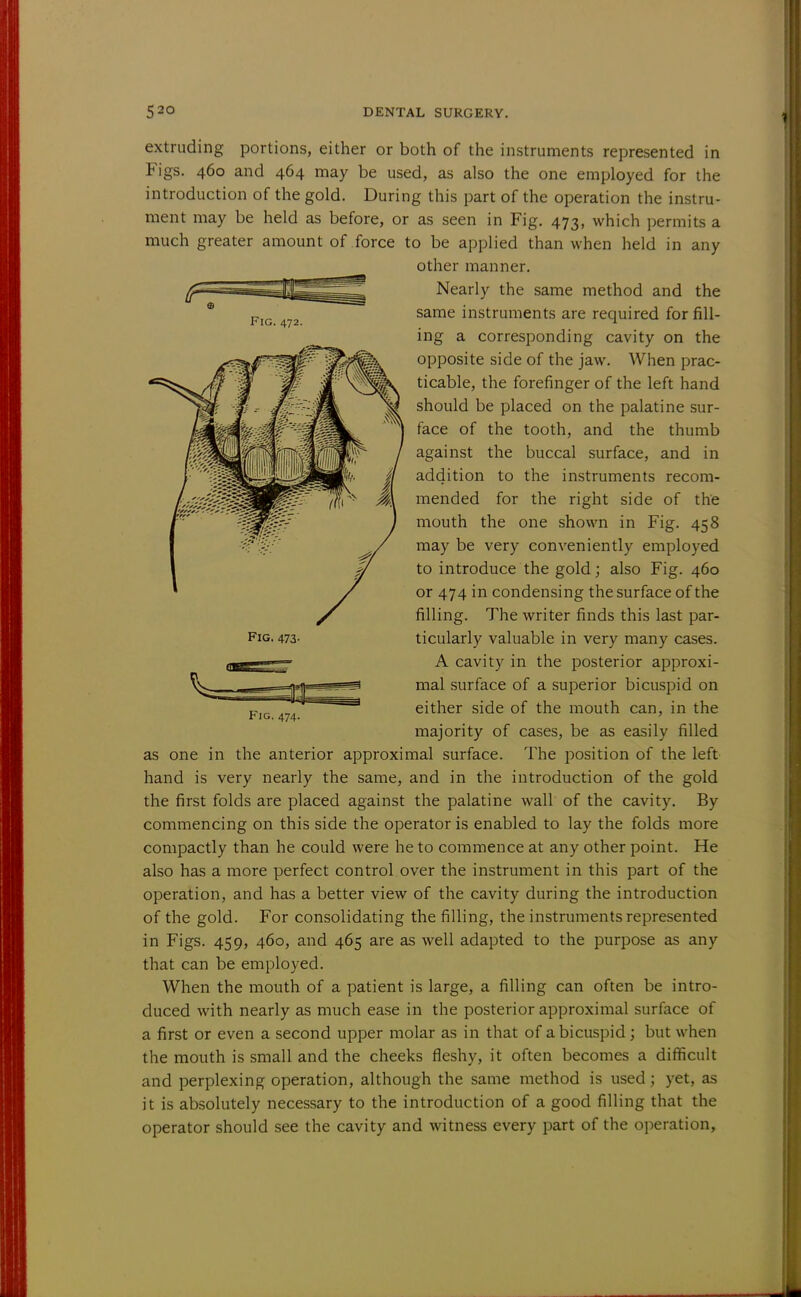 extruding portions, either or both of the instruments represented in Figs. 460 and 464 may be used, as also the one employed for the introduction of the gold. During this part of the operation the instru- ment may be held as before, or as seen in Fig. 473, which permits a much greater amount of force to be applied than when held in any other manner. Nearly the same method and the same instruments are required for fill- ing a corresponding cavity on the opposite side of the jaw. When prac- ticable, the forefinger of the left hand should be placed on the palatine sur- face of the tooth, and the thumb against the buccal surface, and in addition to the instruments recom- mended for the right side of the mouth the one shown in Fig. 458 may be very conveniently employed to introduce the gold; also Fig. 460 or 474 in condensing the surface of the filling. The writer finds this last par- ticularly valuable in very many cases. A cavity in the posterior approxi- mal surface of a superior bicuspid on either side of the mouth can, in the majority of cases, be as easily filled as one in the anterior approximal surface. The position of the left hand is very nearly the same, and in the introduction of the gold the first folds are placed against the palatine wall of the cavity. By commencing on this side the operator is enabled to lay the folds more compactly than he could were he to commence at any other point. He also has a more perfect control over the instrument in this part of the operation, and has a better view of the cavity during the introduction of the gold. For consolidating the filling, the instruments represented in Figs. 459, 460, and 465 are as well adapted to the purpose as any that can be employed. When the mouth of a patient is large, a filling can often be intro- duced with nearly as much ease in the posterior approximal surface of a first or even a second upper molar as in that of a bicuspid; but when the mouth is small and the cheeks fleshy, it often becomes a difficult and perplexing operation, although the same method is used; yet, as it is absolutely necessary to the introduction of a good filling that the operator should see the cavity and witness every part of the operation,