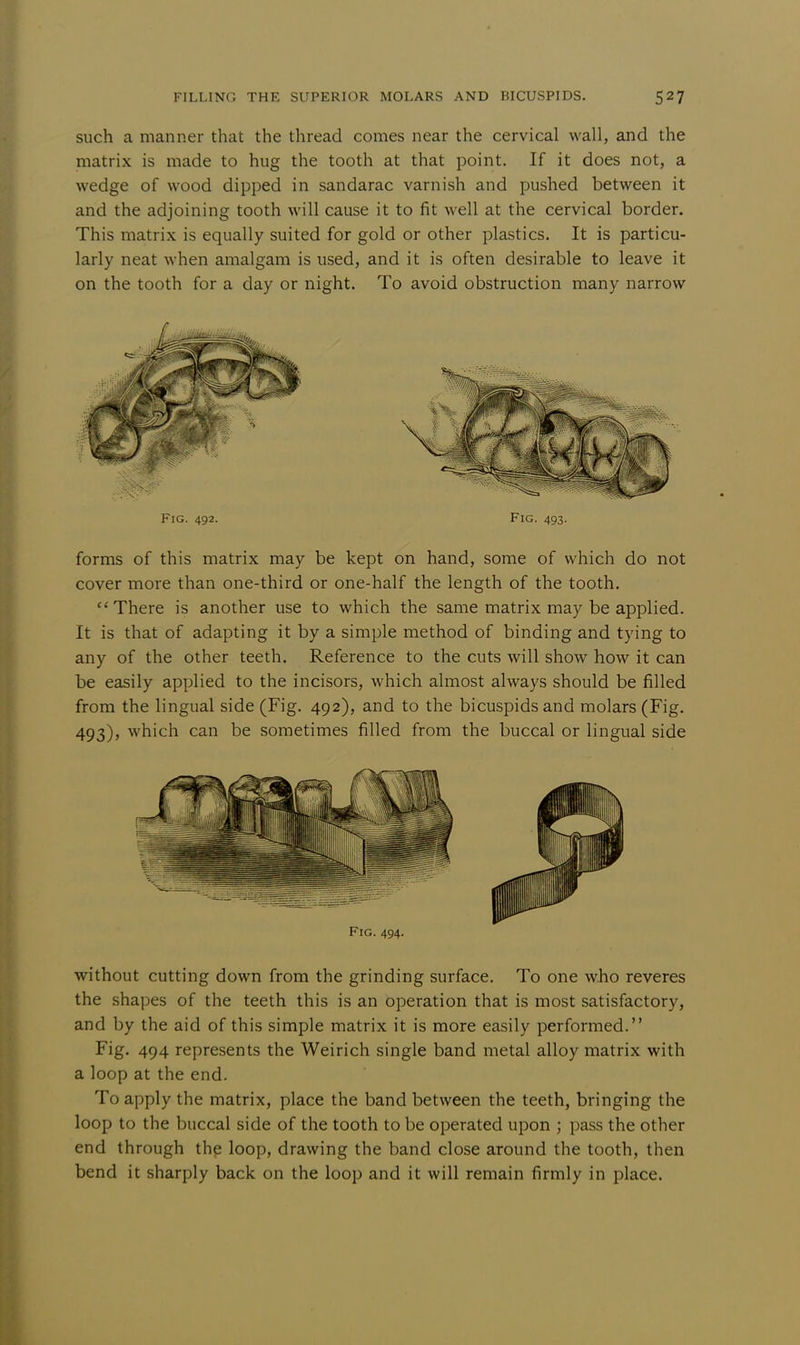 such a manner that the thread comes near the cervical wall, and the matrix is made to hug the tooth at that point. If it does not, a wedge of wood dipped in sandarac varnish and pushed between it and the adjoining tooth will cause it to fit well at the cervical border. This matrix is equally suited for gold or other plastics. It is particu- larly neat when amalgam is used, and it is often desirable to leave it on the tooth for a day or night. To avoid obstruction many narrow Fig. 492. Fig. 493. forms of this matrix may be kept on hand, some of which do not cover more than one-third or one-half the length of the tooth. There is another use to which the same matrix may be applied. It is that of adapting it by a simple method of binding and tying to any of the other teeth. Reference to the cuts will show how it can be easily applied to the incisors, which almost always should be filled from the lingual side (Fig. 492), and to the bicuspids and molars (Fig. 493), which can be sometimes filled from the buccal or lingual side Fig. 494. without cutting down from the grinding surface. To one who reveres the shapes of the teeth this is an operation that is most satisfactory, and by the aid of this simple matrix it is more easily performed. Fig. 494 represents the Weirich single band metal alloy matrix with a loop at the end. To apply the matrix, place the band between the teeth, bringing the loop to the buccal side of the tooth to be operated upon ; pass the other end through the loop, drawing the band close around the tooth, then bend it sharply back on the loop and it will remain firmly in place.