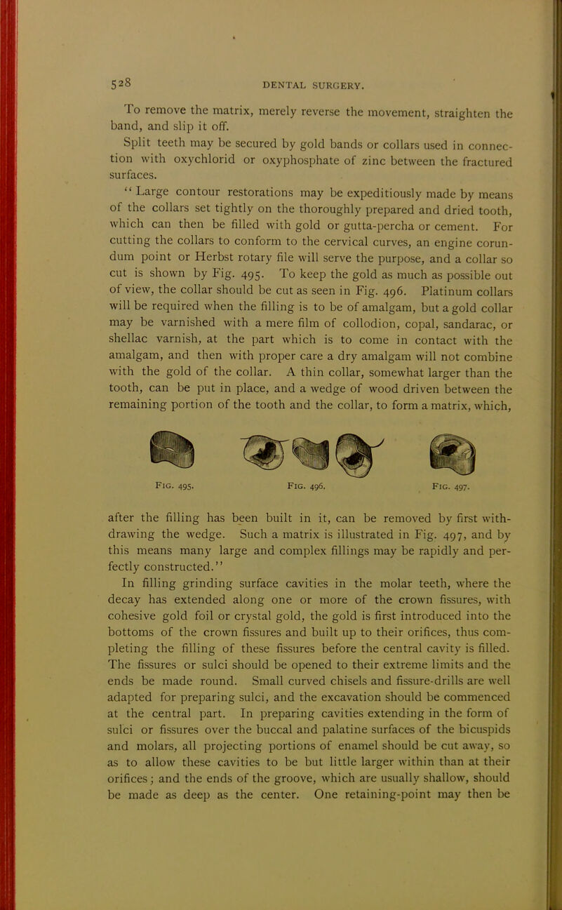 To remove the matrix, merely reverse the movement, straighten the band, and slip it off. Split teeth may be secured by gold bands or collars used in connec- tion with oxychlorid or oxyphosphate of zinc between the fractured surfaces.  Large contour restorations may be expeditiously made by means of the collars set tightly on the thoroughly prepared and dried tooth, which can then be filled with gold or gutta-percha or cement. For cutting the collars to conform to the cervical curves, an engine corun- dum point or Herbst rotary file will serve the purpose, and a collar so cut is shown by Fig. 495. To keep the gold as much as possible out of view, the collar should be cut as seen in Fig. 496. Platinum collars will be required when the filling is to be of amalgam, but a gold collar may be varnished with a mere film of collodion, copal, sandarac, or shellac varnish, at the part which is to come in contact with the amalgam, and then with proper care a dry amalgam will not combine with the gold of the collar. A thin collar, somewhat larger than the tooth, can be put in place, and a wedge of wood driven between the remaining portion of the tooth and the collar, to form a matrix, which, Fig. 495. Fig. 496. Fig. 497. after the filling has been built in it, can be removed by first with- drawing the wedge. Such a matrix is illustrated in Fig. 497, and by this means many large and complex fillings may be rapidly and per- fectly constructed. In filling grinding surface cavities in the molar teeth, where the decay has extended along one or more of the crown fissures, with cohesive gold foil or crystal gold, the gold is first introduced into the bottoms of the crown fissures and built up to their orifices, thus com- pleting the filling of these fissures before the central cavity is filled. The fissures or sulci should be opened to their extreme limits and the ends be made round. Small curved chisels and fissure-drills are well adapted for preparing sulci, and the excavation should be commenced at the central part. In preparing cavities extending in the form of sulci or fissures over the buccal and palatine surfaces of the bicuspids and molars, all projecting portions of enamel should be cut away, so as to allow these cavities to be but little larger within than at their orifices; and the ends of the groove, which are usually shallow, should be made as deep as the center. One retaining-point may then be