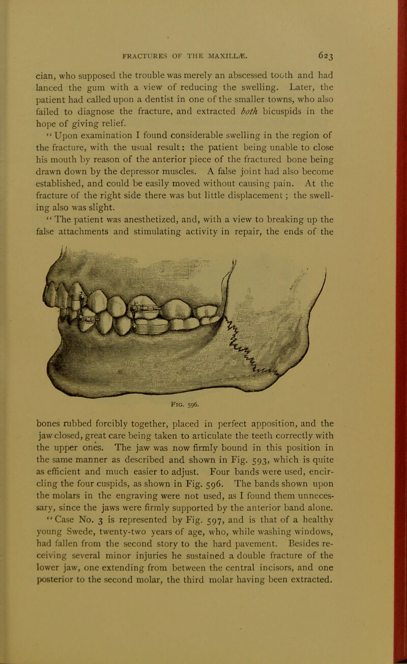 cian, who supposed the trouble was merely an abscessed tooth and had lanced the gum with a view of reducing the swelling. Later, the patient had called upon a dentist in one of the smaller towns, who also failed to diagnose the fracture, and extracted both bicuspids in the hope of giving relief.  Upon examination I found considerable swelling in the region of the fracture, with the usual result: the patient being unable to close his mouth by reason of the anterior piece of the fractured bone being drawn down by the depressor muscles. A false joint had also become established, and could be easily moved without causing pain. At the fracture of the right side there was but little displacement; the swell- ing also was slight.  The patient was anesthetized, and, with a view to breaking up the false attachments and stimulating activity in repair, the ends of the Fig. 596. bones rubbed forcibly together, placed in perfect apposition, and the jaw closed, great care being taken to articulate the teeth correctly with the upper ones. The jaw was now firmly bound in this position in the same manner as described and shown in Fig. 593, which is quite as efficient and much easier to adjust. Four bands were used, encir- cling the four cuspids, as shown in Fig. 596. The bands shown upon the molars in the engraving were not used, as I found them unneces- sary, since the jaws were firmly supported by the anterior band alone. Case No. 3 is represented by Fig. 597, and is that of a healthy young Swede, twenty-two years of age, who, while washing windows, had fallen from the second story to the hard pavement. Besides re- ceiving several minor injuries he sustained a double fracture of the lower jaw, one extending from between the central incisors, and one posterior to the second molar, the third molar having been extracted.