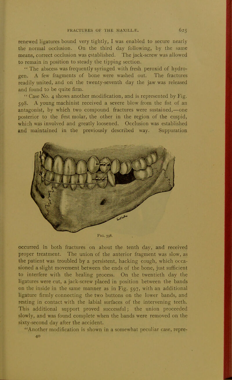 renewed ligatures bound very tightly, I was enabled to secure nearly the normal occlusion. On the third day following, by the same means, correct occlusion was established. The jack-screw was allowed to remain in position to steady the tipping section. The abscess was frequently syringed with fresh peroxid of hydro- gen. A few fragments of bone were washed out. The fractures readily united, and on the twenty-seventh day the jaw was released and found to be quite firm.  Case No. 4 shows another modification, and is represented by Fig. 59S. A young machinist received a severe blow from the fist of an antagonist, by which two compound fractures were sustained,—one posterior to the first molar, the other in the region of the cuspid, which was involved and greatly loosened. Occlusion was established and maintained in the previously described way. Suppuration Fig. 598. occurred in both fractures on about the tenth day, and received proper treatment. The union of the anterior fragment was slow, as the patient was troubled by a persistent, hacking cough, which occa- sioned a slight movement between the ends of the bone, just sufficient to interfere with the healing process. On the twentieth day the ligatures were cut, a jack-screw placed in position between the bands on the inside in the same manner as in Fig. 597, with an additional ligature firmly connecting the two buttons on the lower bands, and resting in contact with the labial surfaces of the intervening teeth. This additional support proved successful; the union proceeded slowly, and was found complete when the bands were removed on the sixty-second day after the accident. Another modification is shown in a somewhat peculiar case, repre- 40