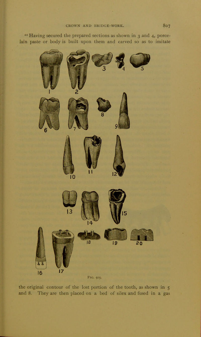  Having secured the prepared sections as shown in 3 and 4, porce- lain paste or body is built upon them and carved so as to imitate Fig. 915. the original contour of the lost portion of the tooth, as shown in 5 and 8. They are then placed on a bed of si lex and fused in a gas