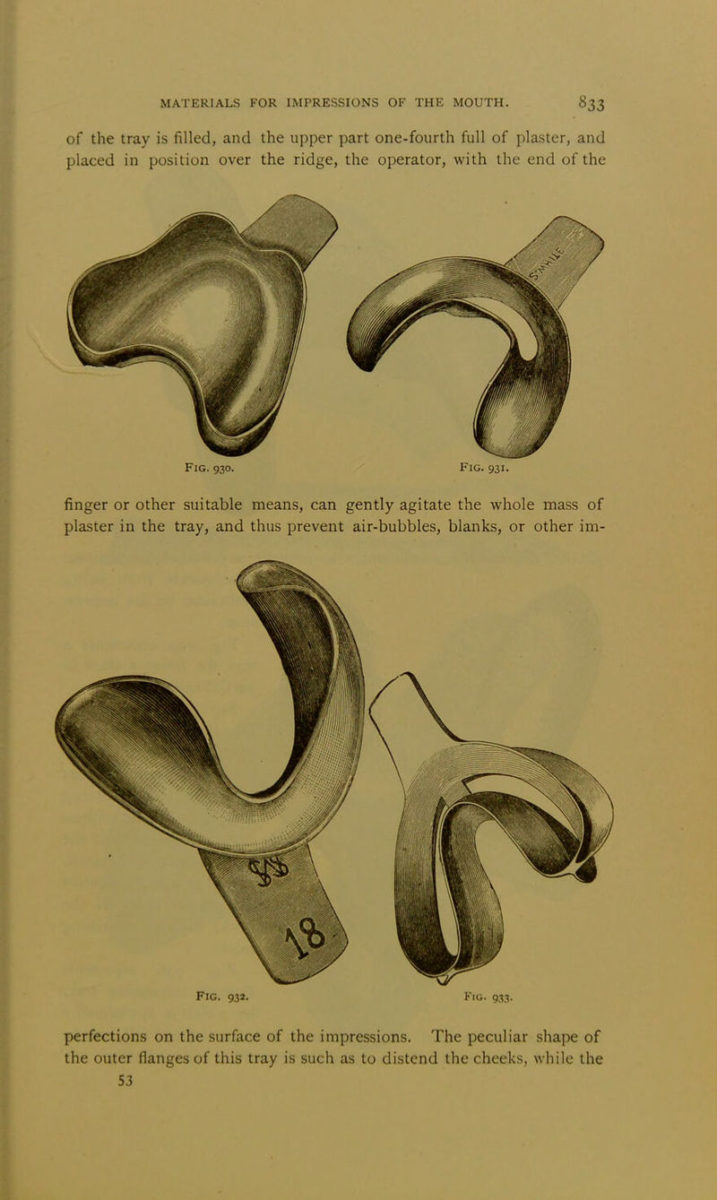 of the tray is filled, and the upper part one-fourth full of plaster, and placed in position over the ridge, the operator, with the end of the Fig. 930. Fig. 931. finger or other suitable means, can gently agitate the whole mass of plaster in the tray, and thus prevent air-bubbles, blanks, or other im- FiG. 932. Fig. 933. perfections on the surface of the impressions. The peculiar shape of the outer flanges of this tray is such as to distend the cheeks, while the 53