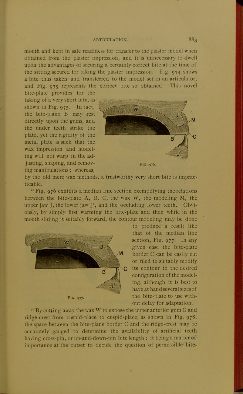 Fig. .976. mouth and kept in safe readiness for transfer to the plaster model when obtained from the plaster impression, and it is unnecessary to dwell upon the advantages of securing a certainly correct bite at the time of the sitting secured for taking the plaster impression. Fig. 974 shows a bite thus taken and transferred to the model set in an articulator, and Fig. 975 represents the correct bite so obtained. This novel bite-plate provides for the taking of a very short bite, as shown in Fig. 975. In fact, the bite-plane B may rest directly upon the gums, and the under teeth strike the plate, yet the rigidity of the metal plate is such that the wax impression and model- ing will not warp in the ad- justing, shaping, and remov- ing manipulations; whereas, by the old mere wax methods, a trustworthy very short bite is imprac- ticable.  Fig. 976 exhibits a median line section exemplifying the relations between the bite-plate A, B, C, the wax W, the modeling M, the upper jaw J, the lower jaw J1, and the occluding lower teeth. Obvi- ously, by simply first warming the bite-plate and then while in the mouth sliding it suitably forward, the contour modeling may be done to produce a result like that of the median line section, Fig. 977. In any given case the bite-plate border C can be easily cut or filed to suitably modify its contour to the desired configuration of the model- ing, although it is best to have at hand several sizes of the bite-plate to use with- out delay for adaptation.  By cutting away the wax W to expose the upper anterior gum G and ridge-crest from cuspid-place to cuspid-place, as shown in Fig. 978, the space between the bite-plane border C and the ridge-crest may be accurately gauged to determine the availability of artificial teeth having cross-pin, or up-and-down-pin bite length ; it being a matter of importance at the outset to decide the question of permissible bite- Fig. 977-