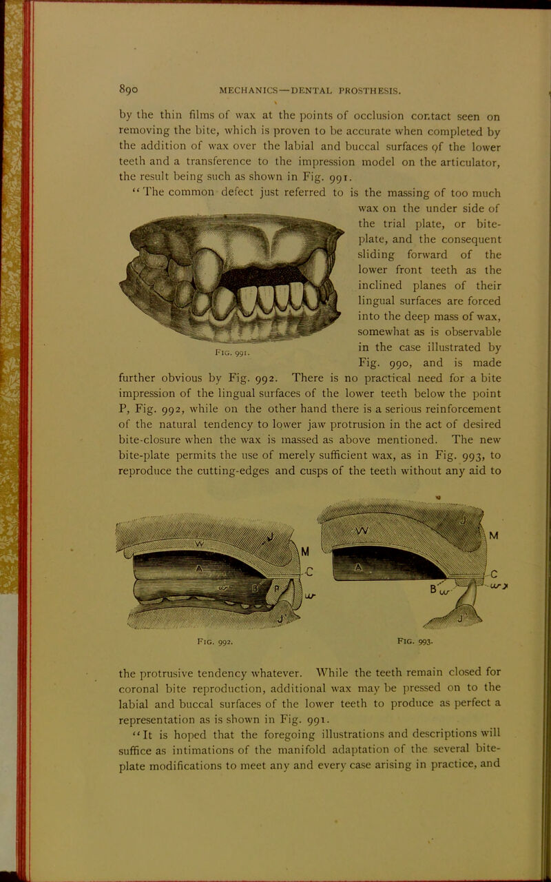 by the thin films of wax at the points of occlusion contact seen on removing the bite, which is proven to be accurate when completed by the addition of wax over the labial and buccal surfaces of the lower teeth and a transference to the impression model on the articulator, the result being such as shown in Fig. 991.  The common defect just referred to is the massing of too much wax on the under side of the trial plate, or bite- plate, and the consequent sliding forward of the lower front teeth as the inclined planes of their lingual surfaces are forced into the deep mass of wax, somewhat as is observable in the case illustrated by Fig. 990, and is made further obvious by Fig. 992. There is no practical need for a bite impression of the lingual surfaces of the lower teeth below the point P, Fig. 992, while on the other hand there is a serious reinforcement of the natural tendency to lower jaw protrusion in the act of desired bite-closure when the wax is massed as above mentioned. The new bite-plate permits the use of merely sufficient wax, as in Fig. 993, to reproduce the cutting-edges and cusps of the teeth without any aid to Fig. 991. Fig. 993- the protrusive tendency whatever. While the teeth remain closed for coronal bite reproduction, additional wax may be pressed on to the labial and buccal surfaces of the lower teeth to produce as perfect a representation as is shown in Fig. 991. It is hoped that the foregoing illustrations and descriptions will suffice as intimations of the manifold adaptation of the several bite- plate modifications to meet any and every case arising in practice, and