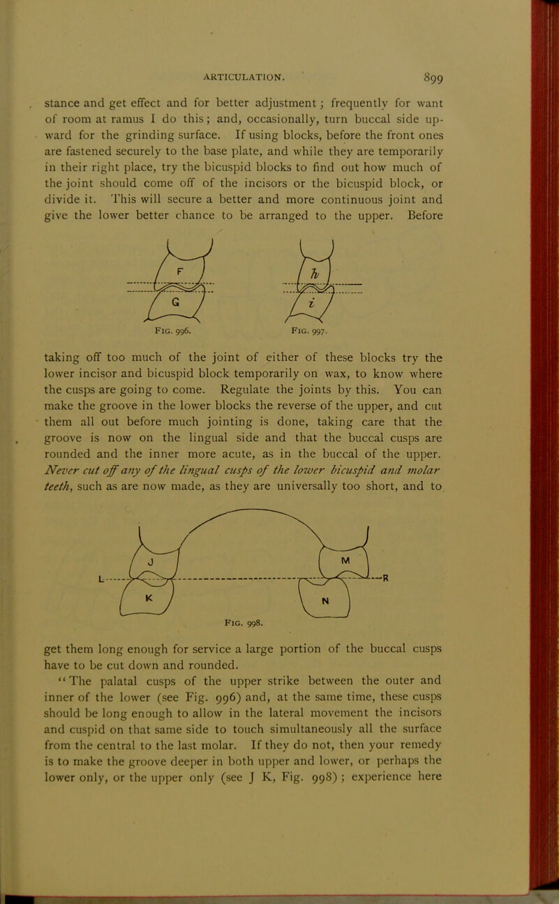 stance and get effect and for better adjustment; frequently for want of room at ramus I do this; and, occasionally, turn buccal side up- ward for the grinding surface. If using blocks, before the front ones are fastened securely to the base plate, and while they are temporarily in their right place, try the bicuspid blocks to find out how much of the joint should come off of the incisors or the bicuspid block, or divide it. This will secure a better and more continuous joint and give the lower better chance to be arranged to the upper. Before Fig. 996. Fig. 997. taking off too much of the joint of either of these blocks try the lower incisor and bicuspid block temporarily on wax, to know where the cusps are going to come. Regulate the joints by this. You can make the groove in the lower blocks the reverse of the upper, and cut them all out before much jointing is done, taking care that the groove is now on the lingual side and that the buccal cusps are rounded and the inner more acute, as in the buccal of the upper. Never cut off any of the lingual cusps of the lower bicuspid and molar teeth, such as are now made, as they are universally too short, and to Fig. 998. get them long enough for service a large portion of the buccal cusps have to be cut down and rounded. The palatal cusps of the upper strike between the outer and inner of the lower (see Fig. 996) and, at the same time, these cusps should be long enough to allow in the lateral movement the incisors and cuspid on that same side to touch simultaneously all the surface from the central to the last molar. If they do not, then your remedy is to make the groove deeper in both upper and lower, or perhaps the lower only, or the upper only (see J K, Fig. 998) ; experience here