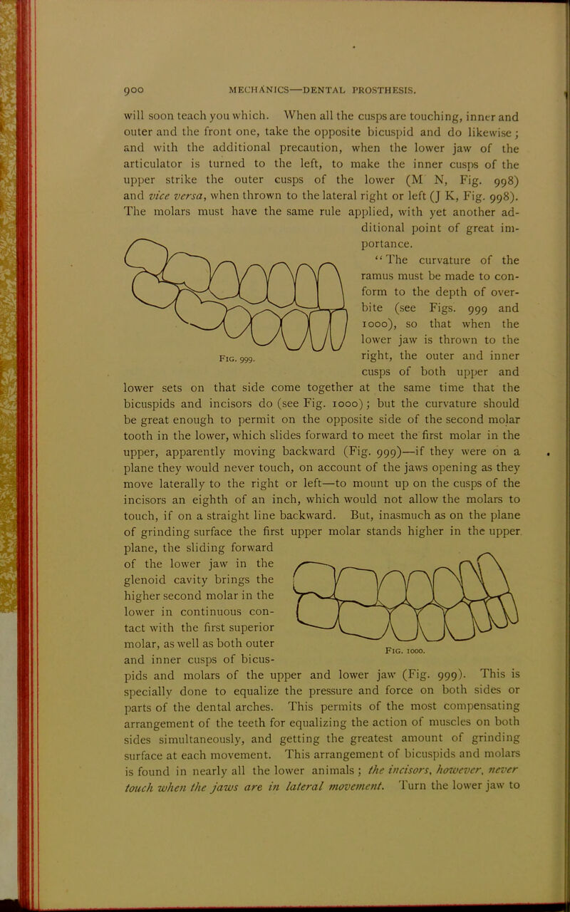 will soon teach you which. When all the cusps are touching, inner and outer and the front one, take the opposite bicuspid and do likewise; and with the additional precaution, when the lower jaw of the articulator is turned to the left, to make the inner cusps of the upper strike the outer cusps of the lower (M N, Fig. 998) and vice versa, when thrown to the lateral right or left (J K, Fig. 998). The molars must have the same rule applied, with yet another ad- ditional point of great im- portance. The curvature of the ramus must be made to con- form to the depth of over- bite (see Figs. 999 and 1000), so that when the lower jaw is thrown to the Fig. 999. right* the outer and inner cusps of both upper and lower sets on that side come together at the same time that the bicuspids and incisors do (see Fig. 1000); but the curvature should be great enough to permit on the opposite side of the second molar tooth in the lower, which slides forward to meet the first molar in the upper, apparently moving backward (Fig. 999)—if they were on a plane they would never touch, on account of the jaws opening as they move laterally to the right or left—to mount up on the cusps of the incisors an eighth of an inch, which would not allow the molars to touch, if on a straight line backward. But, inasmuch as on the plane of grinding surface the first upper molar stands higher in the upper, plane, the sliding forward of the lower jaw in the glenoid cavity brings the higher second molar in the lower in continuous con- tact with the first superior molar, as well as both outer Fig. iooo. and inner cusps of bicus- pids and molars of the upper and lower jaw (Fig. 999). This is specially done to equalize the pressure and force on both sides or parts of the dental arches. This permits of the most compensating arrangement of the teeth for equalizing the action of muscles on both sides simultaneously, and getting the greatest amount of grinding surface at each movement. This arrangement of bicuspids and molars is found in nearly all the lower animals ; the incisors, however, never touch when the jaws are in lateral movement. Turn the lower jaw to