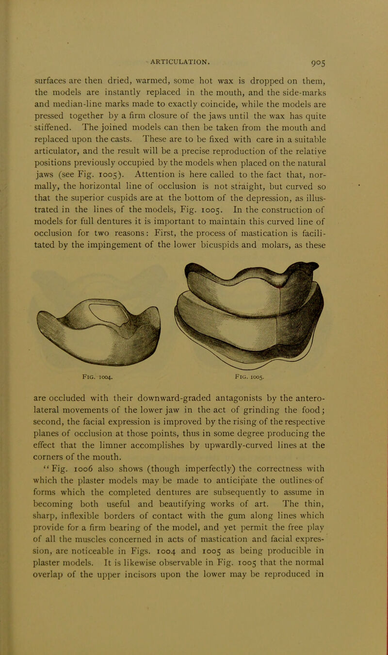 surfaces are then dried, warmed, some hot wax is dropped on them, the models are instantly replaced in the mouth, and the side-marks and median-line marks made to exactly coincide, while the models are pressed together by a firm closure of the jaws until the wax has quite stiffened. The joined models can then be taken from the mouth and replaced upon the casts. These are to be fixed with care in a suitable articulator, and the result will be a precise reproduction of the relative positions previously occupied by the models when placed on the natural jaws (see Fig. 1005). Attention is here called to the fact that, nor- mally, the horizontal line of occlusion is not straight, but curved so that the superior cuspids are at the bottom of the depression, as illus- trated in the lines of the models, Fig. 1005. In the construction of models for full dentures it is important to maintain this curved line of occlusion for two reasons: First, the process of mastication is facili- tated by the impingement of the lower bicuspids and molars, as these are occluded with their downward-graded antagonists by the antero- lateral movements of the lower jaw in the act of grinding the food; second, the facial expression is improved by the rising of the respective planes of occlusion at those points, thus in some degree producing the effect that the limner accomplishes by upwardly-curved lines at the corners of the mouth. Fig. 1006 also shows (though imperfectly) the correctness with which the plaster models may be made to anticipate the outlines of forms which the completed dentures are subsequently to assume in becoming both useful and beautifying works of art. The thin, sharp, inflexible borders of contact with the gum along lines which provide for a firm bearing of the model, and yet permit the free play of all the muscles concerned in acts of mastication and facial expres- sion, are noticeable in Figs. 1004 and 1005 as being producible in plaster models. It is likewise observable in Fig. 1005 that the normal overlap of the upper incisors upon the lower may be reproduced in