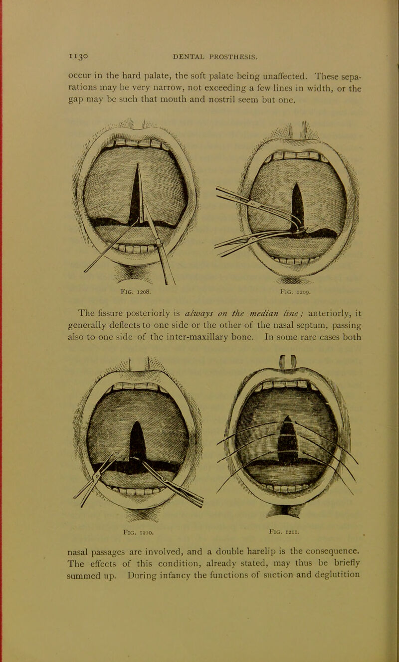 occur in the hard palate, the soft palate being unaffected. These sepa- rations may be very narrow, not exceeding a few lines in width, or the gap may be such that mouth and nostril seem but one. Fig. 1208. Fig. 1209. The fissure posteriorly is always on the median line; anteriorly, it generally deflects to one side or the other of the nasal septum, passing also to one side of the inter-maxillary bone. In some rare cases both Fig. 1210. Fjg. 1211. nasal passages are involved, and a double harelip is the consequence. The effects of this condition, already stated, may thus be briefly summed up. During infancy the functions of suction and deglutition