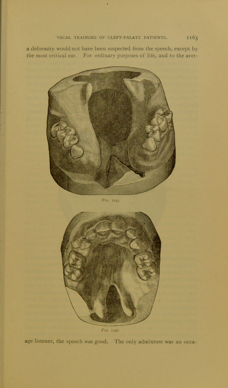 a deformity would not have been suspected from the speech, except by the most critical ear. For ordinary purposes of life, and to the aver- Fig. 1246. age listener, the speech was good. The only admixture was an occa-