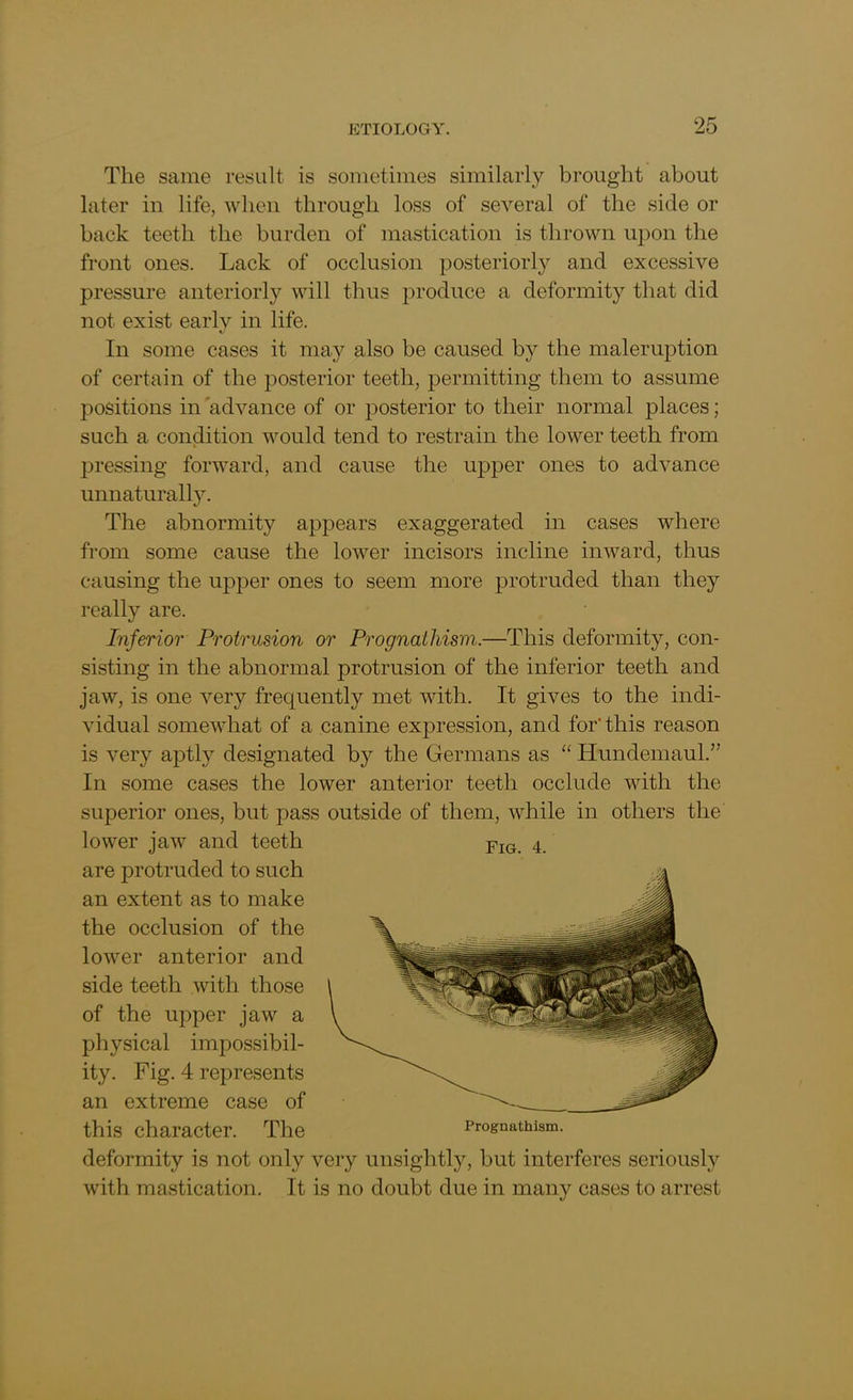 The same result is sometimes similarly brought about later in life, when through loss of several of the side or back teeth the burden of mastication is thrown upon the front ones. Lack of occlusion posteriorly and excessive pressure anteriorly will thus produce a deformity that did not exist early in life. In some cases it may also be caused by the maleruption of certain of the posterior teeth, permitting them to assume positions in 'advance of or posterior to their normal places; such a condition would tend to restrain the lower teeth from pressing forward, and cause the upper ones to advance unnaturally. The abnormity appears exaggerated in cases where from some cause the lower incisors incline inward, thus causing the upper ones to seem more protruded than they really are. Inferior Protrusion or Prognathism.—This deformity, con- sisting in the abnormal protrusion of the inferior teeth and jaw, is one very frequently met with. It gives to the indi- vidual somewhat of a canine expression, and for' this reason is very aptly designated by the Germans as “ Hundemaul.” In some cases the lower anterior teeth occlude with the superior ones, but pass outside of them, while in others the lower jaw and teeth are protruded to such an extent as to make the occlusion of the lower anterior and side teeth with those of the upper jaw a physical impossibil- ity. Fig. 4 represents an extreme case of this character. The deformity is not only very unsightly, but interferes seriously with mastication. It is no doubt due in many cases to arrest Fig. 4.