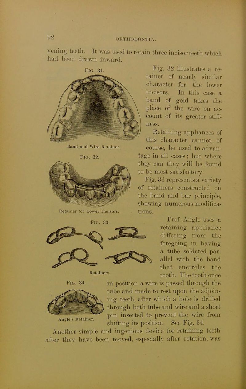 nimiODONTIA. vening teeth. It was used to retain three incisorteeth which Band and Wire Retainer Fig. 32. had been drawn inward. Fig. 3i. big. 32 illustrates a re- tainer of nearly similar character for the lower incisors. In this case a band of gold takes the place of the wire on ac- count of its greater stiff- ness. Retaining appliances of this character cannot, of course, be used to advan- tage in ail cases; but where they can they will be found to be most satisfactory. Fig. 33 represents a variety of retainers constructed on the band and bar principle, showing numerous modifica- tions. Prof. Angle uses a retaining appliance differing from the foregoing in having a tube soldered par- allel with the band that encircles the tooth. The tooth once in position a wire is passed through the tube and made to rest upon the adjoin- ing teeth, after which a hole is drilled through both tube and wire and a short pin inserted to prevent the wire from shifting its position. See Fig. 34. Another simple and ingenious device for retaining teeth after they have been moved, especially after rotation, was Retainer for Lower Incisors FIG. 33 Retainers. Fig. 34. Angle’s Retainer.