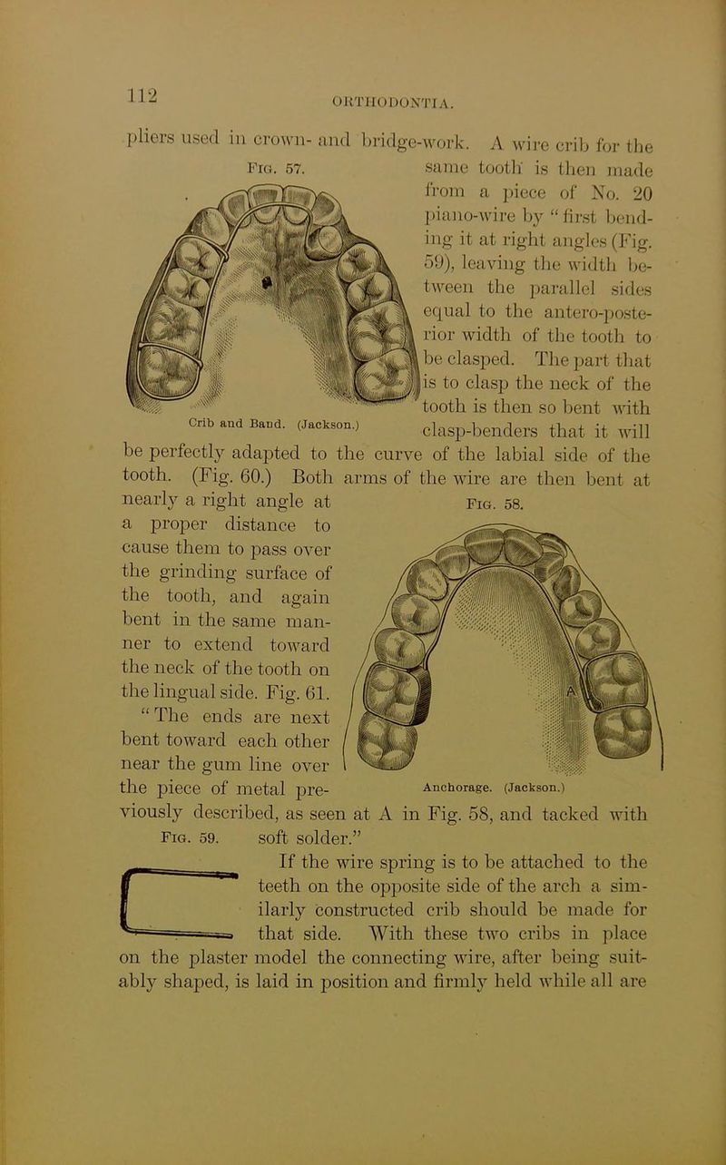 ORTHODONTIA. pliers used in crown- and bridge-work. A wire crib for the Fig. 57. same tooth' is then made from a piece of No. 20 piano-wire by “first bend- ing it at right angles (Fig. 59), leaving the width be- tween the parallel sides equal to the antero-poste- rior width of the tooth to be clasped. The part that is to clasp the neck of the tooth is then so bent with Crib and Band. (Jackson.) clasp-benders that it will be perfectly adapted to the curve of the labial side of the tooth. (Fig. 60.) Both arms of the wire are then bent at nearly a right angle at fig. 58. a proper distance to cause them to pass over the grinding surface of the tooth, and again bent in the same man- ner to extend toward the neck of the tooth on the lingual side. Fig. 61. “ The ends are next bent toward each other near the gum line over the piece of metal pre- Anchorage. (Jackson.) viously described, as seen at A in Fig. 58, and tacked with Fig. 59. soft solder.” If the wire spring is to be attached to the teeth on the opposite side of the arch a sim- ilarly constructed crib should be made for that side. With these two cribs in place on the plaster model the connecting wire, after being suit- ably shaped, is laid in position and firmly held while all are