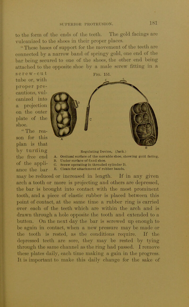 to the form of the ends of the teeth. The gold facings are vulcanized to the shoes in their proper places. “ These bases of support for the movement of the teeth are connected by a narrow band of springy gold, one end of the bar being secured to one of the shoes, the other end being attached to the opposite shoe by a male screw fitting in a screw-cut fig. 151. tube or, with proper pre- cautions, vul- canized into a projection on the outer plate of the shoe. “ The rea- son for this plan is that by turning the free end of the appli- ance the bar may be reduced or increased in length. If in any given arch a tooth or more is projecting and others are depressed, the bar is brought into contact with the most prominent tooth, and a piece of elastic rubber is placed between this point of contact, at the same time a rubber ring is carried over each of the teeth which are within the arch and is drawn through a hole opposite the tooth and extended to a button. On the next day the bar is screwed up enough to be again in contact, when a new pressure may be made or the tooth is rested, as the conditions require. If the depressed teeth are sore, they may be rested by tying through the same channel as the ring had passed. 1 remove these plates daily, eacli time making a gain in the progress. It is important to make this daily change for the sake of Regulating Device. (Jack.) A. Occlusal surface of the movable shoe, showing gold facing. B. Under surface of fixed shoe. C. Screw operating in threaded cylinder D. E. Cleats for attachment of rubber bands.