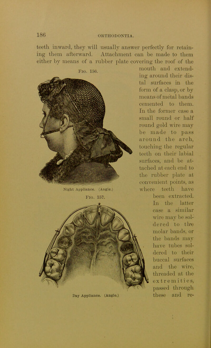 FIG. 156. teeth inward, they will usually answer perfectly for retain- ing them afterward. Attachment can be made to them either by means of a rubber plate covering the roof of the mouth and extend- ing around their dis- tal surfaces in the form of a clasp, or by means of metal bands cemented to them. In the former case a small round or half round gold wire may be made to pass around the arch, touching the regular teeth on their labial surfaces, and be at- tached at each end to the rubber plate at convenient points, as where teeth have been extracted. In the latter case a similar wire may be sol- dered to tire molar bands, or the bands may have tubes sol- dered to their buccal surfaces and the wire, threaded at the extremitie s, passed through these and re- Night Appliance. (Angle.) Fig. 157. Day Appliance. (Angle.)