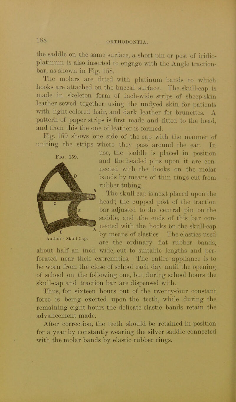 the saddle on the same, surface, a short pin or post of iridio- platinum is also inserted to engage with the Angle traction- bar, as shown in Fig. 158. The molars are fitted with platinum bands to which hooks are attached on the buccal surface. The skull-cap is made in skeleton form of inch-wide strips of sheep-skin Fig. 159. leather sewed together, using the undyed skin for patients with light-colored hair, and dark leather for brunettes. A pattern of paper strips is first made and fitted to the head, and from this the one of leather is formed. Fig. 159 shows one side of the cap with the manner of uniting the strips where they pass around the ear. In use, the saddle is placed in position and the headed pins upon it are con- nected with the hooks on the molar bands by means of thin rings cut from rubber tubing. The skull-cap is next placed upon the head ; the cupped post of the traction bar adjusted to the central pin on the saddle, and the ends of this bar con- nected with the hooks bn the skull-cap by means of elastics. The elastics used are the ordinary flat rubber bands, about half an inch wide, cut to suitable lengths and per- forated near their extremities. The entire appliance is to be worn from the close of school each day until the opening of school on the following one, but during school hours the skull-cap and traction bar are dispensed with. Thus, for sixteen hours out of the twenty-four constant force is being exerted upon the teeth, while during the remaining eight hours the delicate elastic bands retain the advancement made. After correction, the teeth should be retained in position for a year by constantly wearing the silver saddle connected with the molar bands by elastic rubber rings. Author’s Skull-Cap.